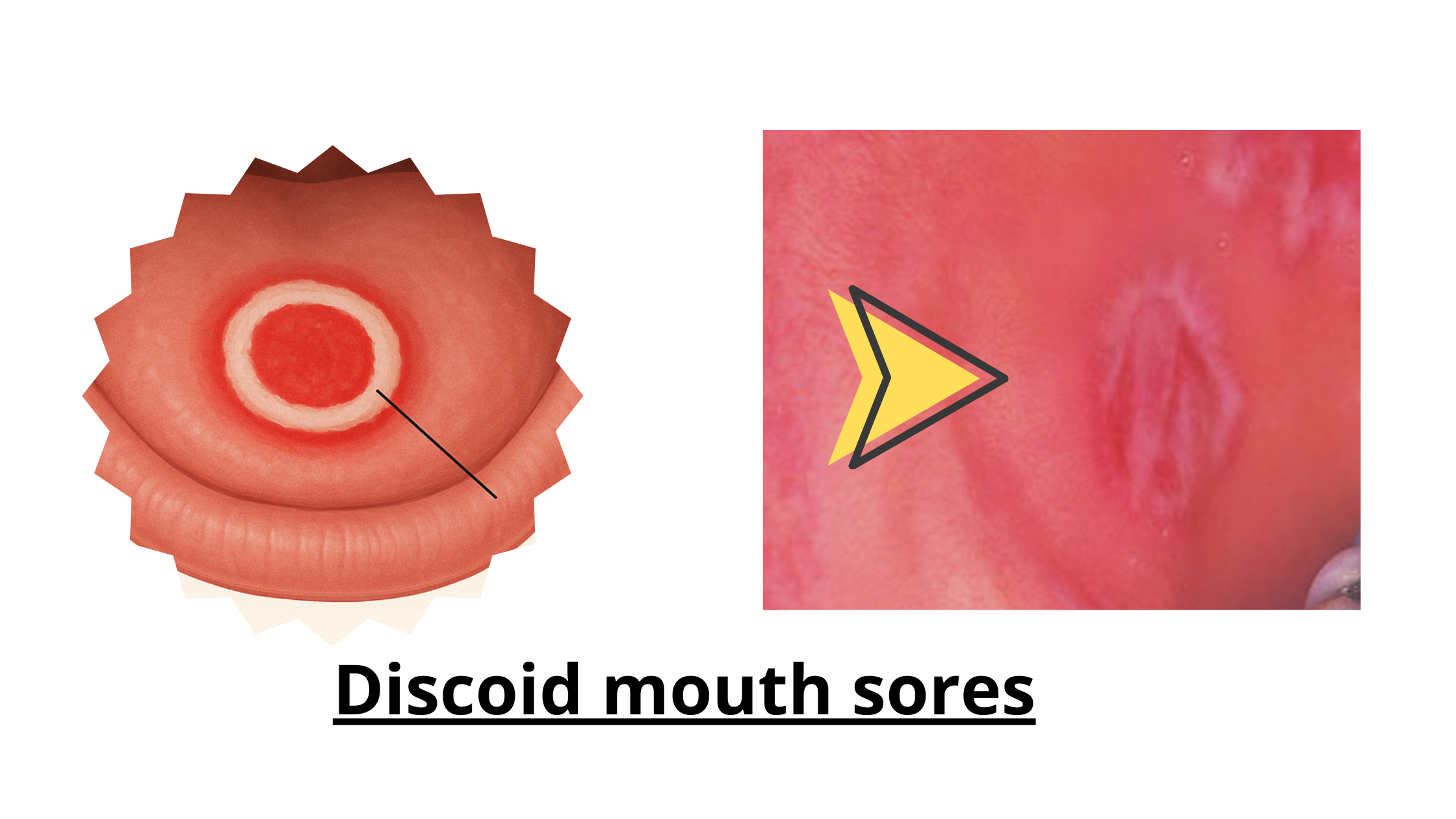 Discoid mouth sores: clinical and educational image