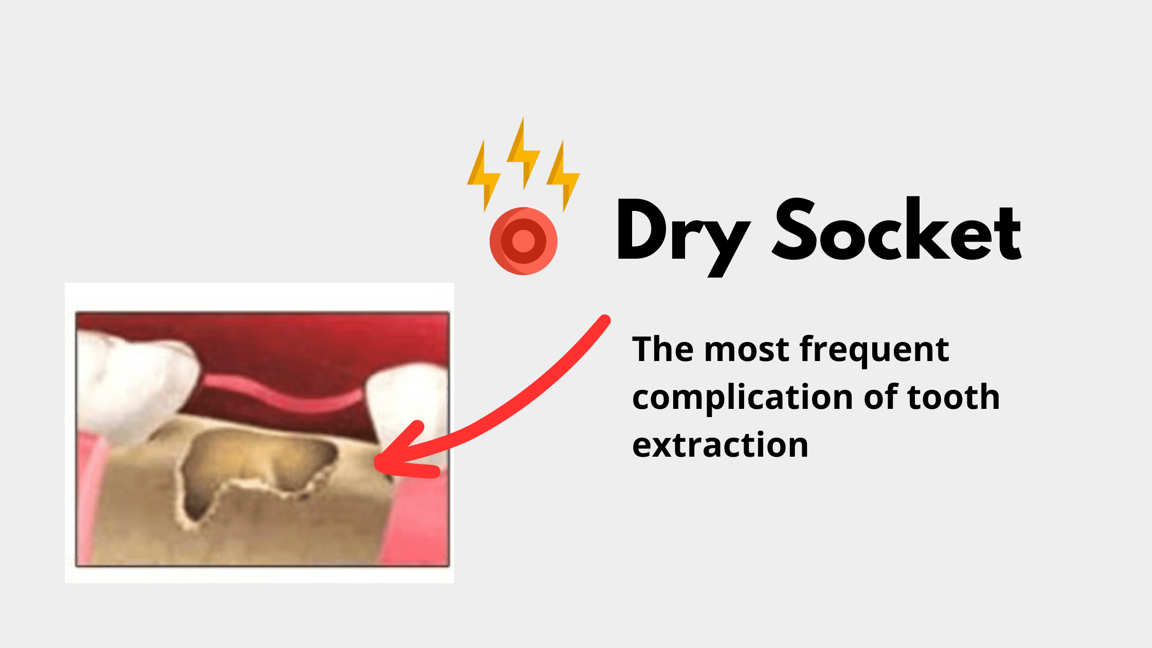 Dry socket: The Most Common Complication After Tooth Extraction