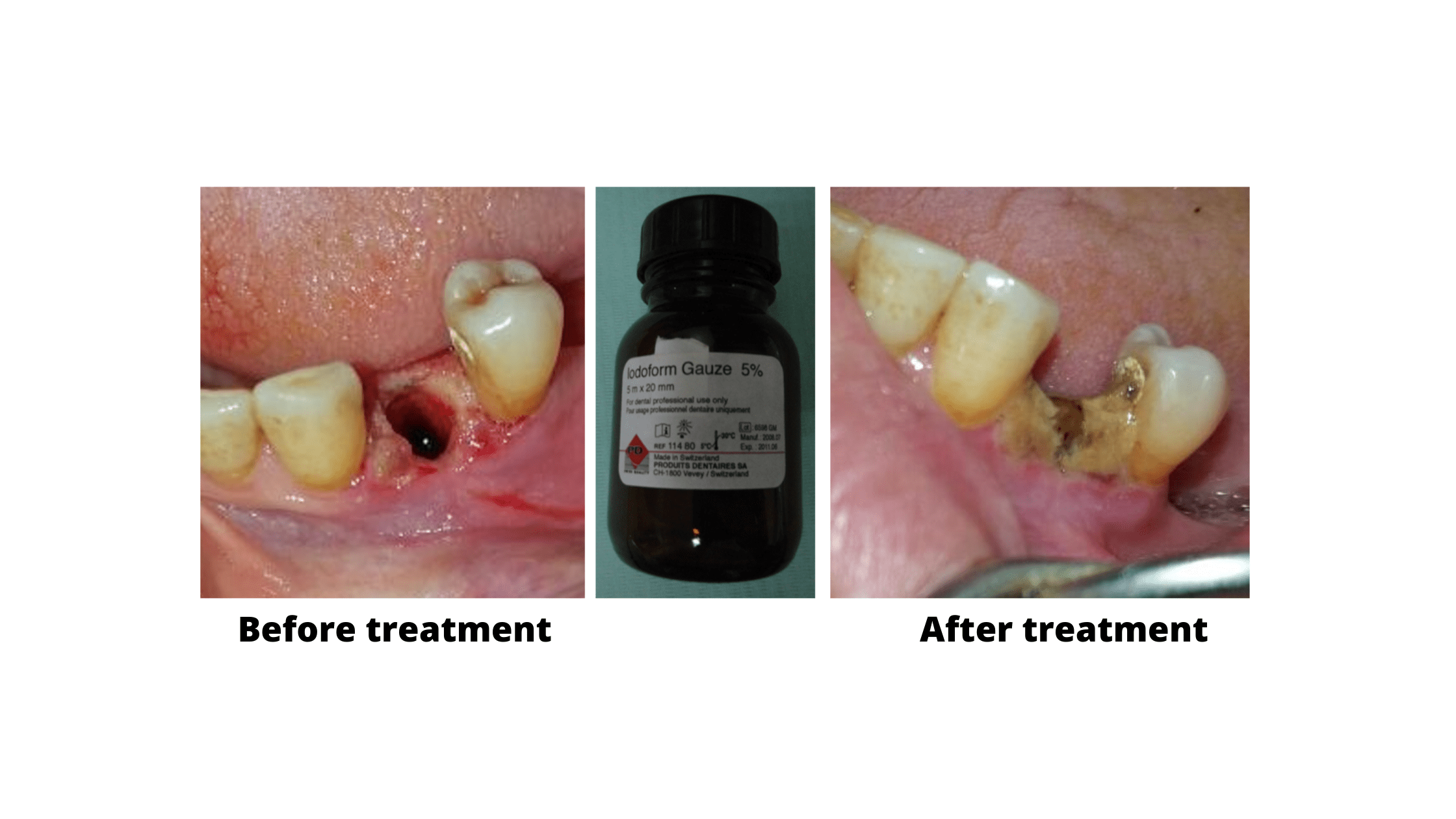 Dry socket before and after treatment (with Iodoform Gauze 5%): Clinical images