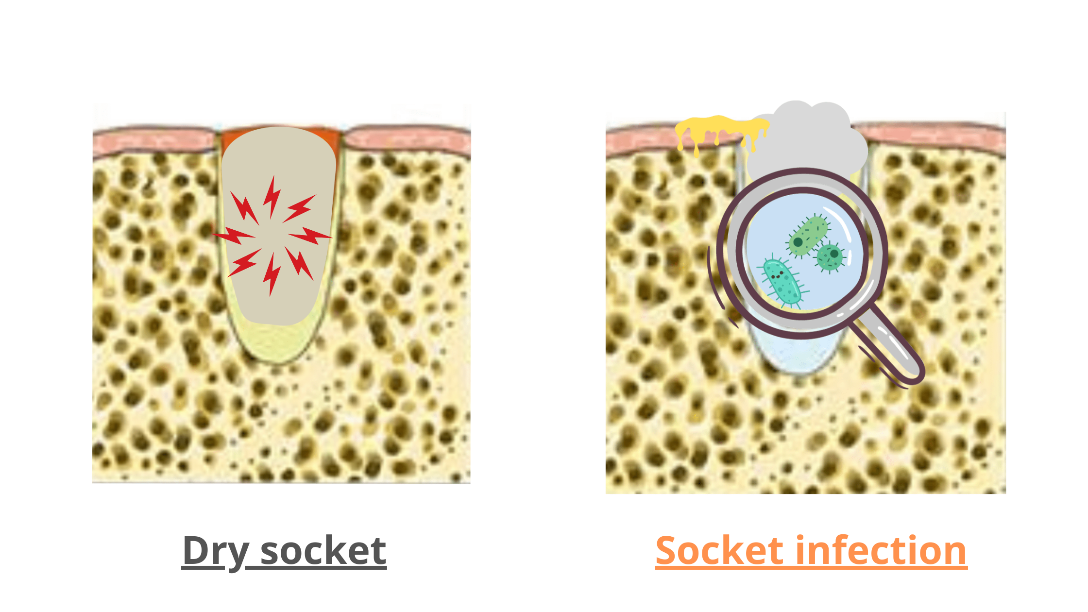 dry socket vs. socket infection
