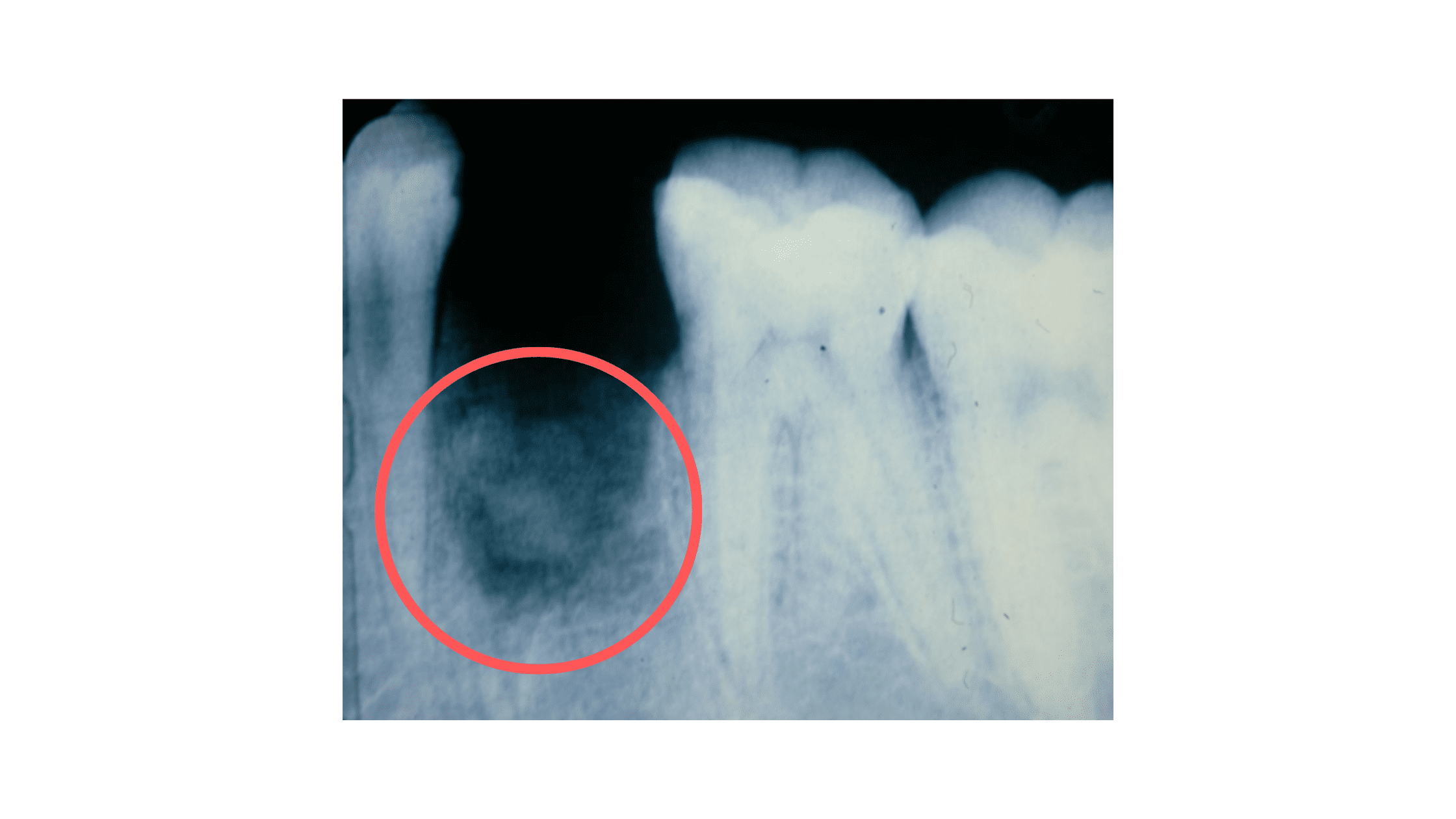 How does dry socket appear on X-rays?