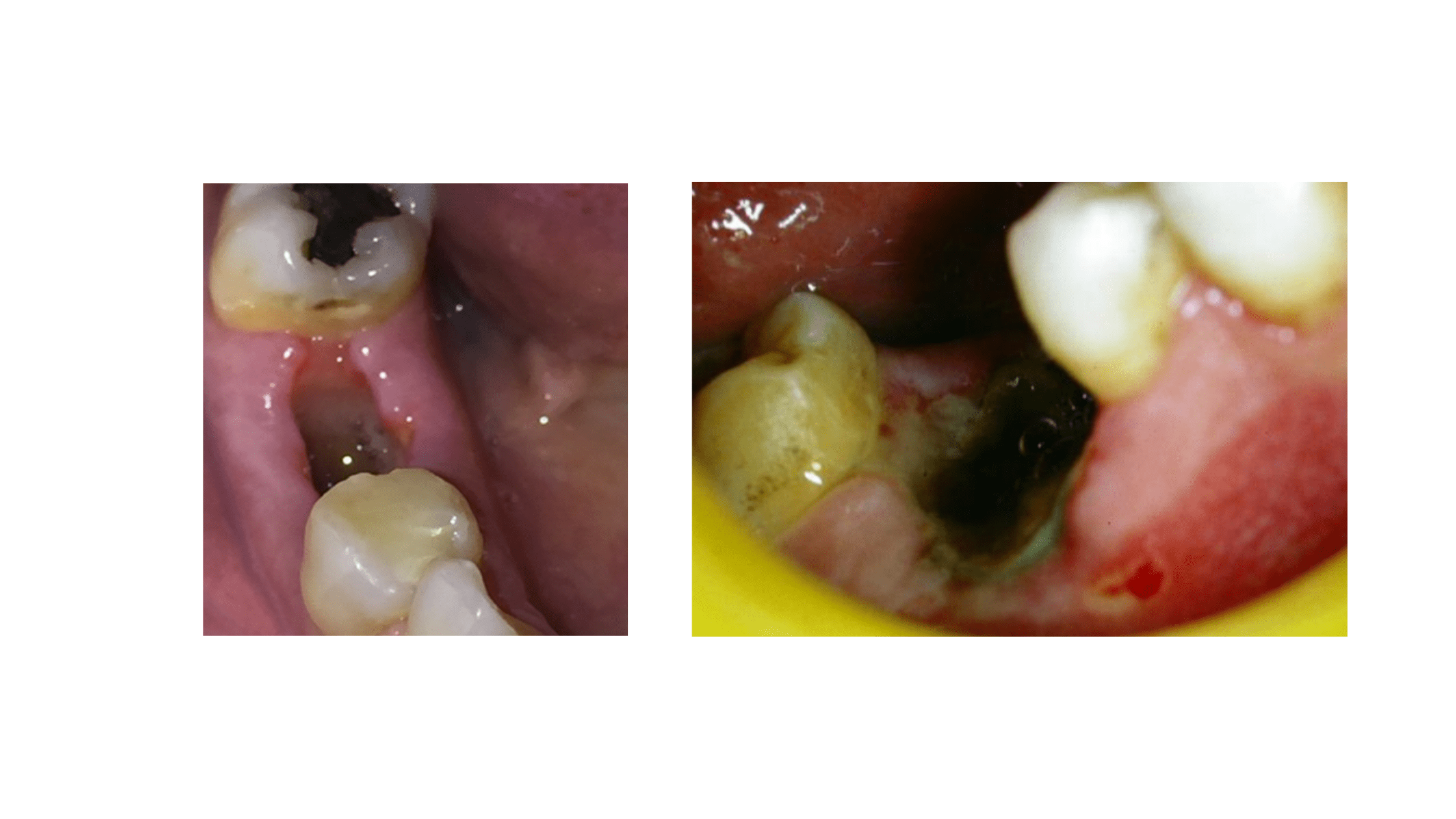 dry socket after tooth extraction: clinical images