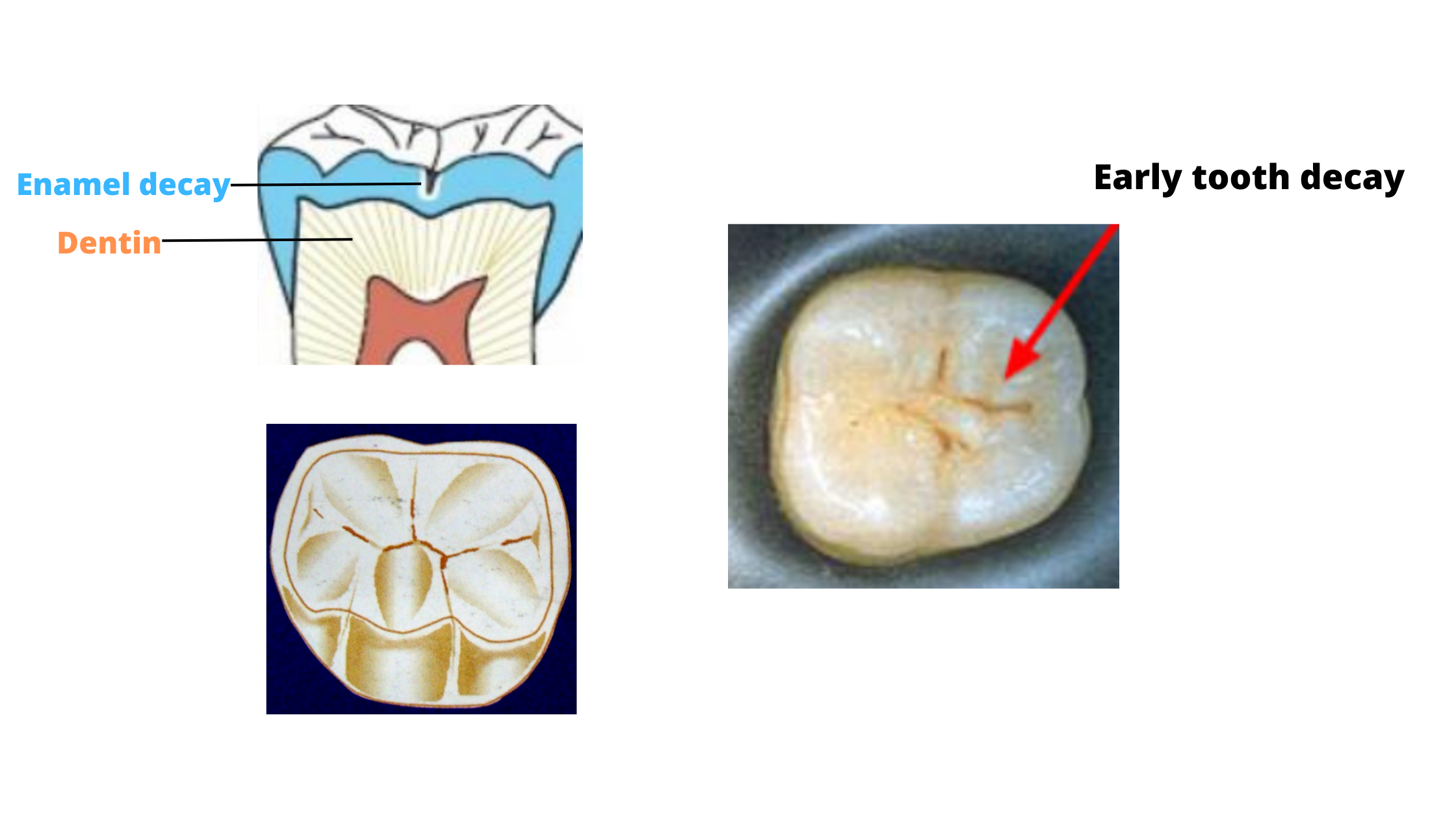 early tooth decay on a molar