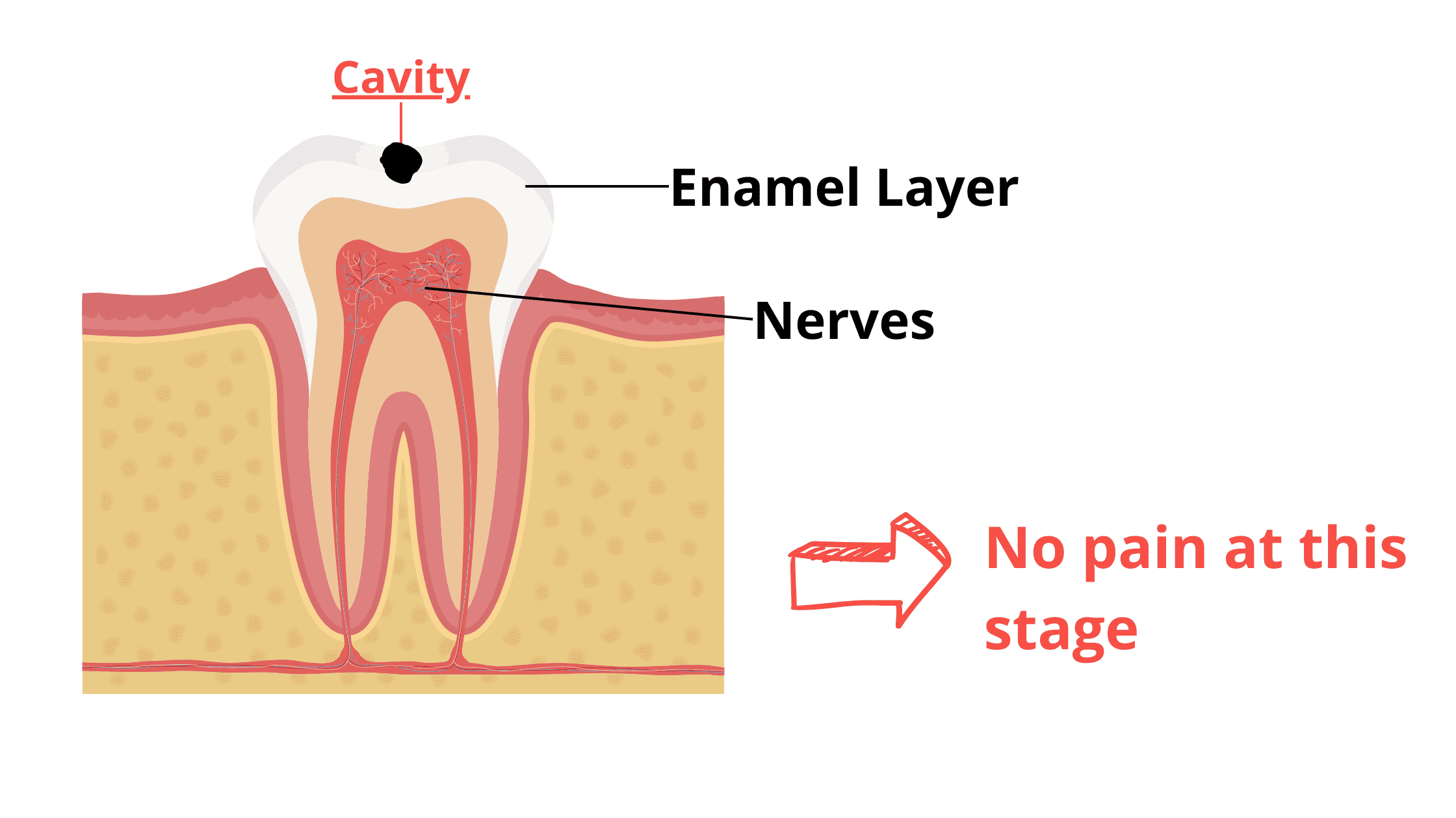 Enamel cavity is not painful