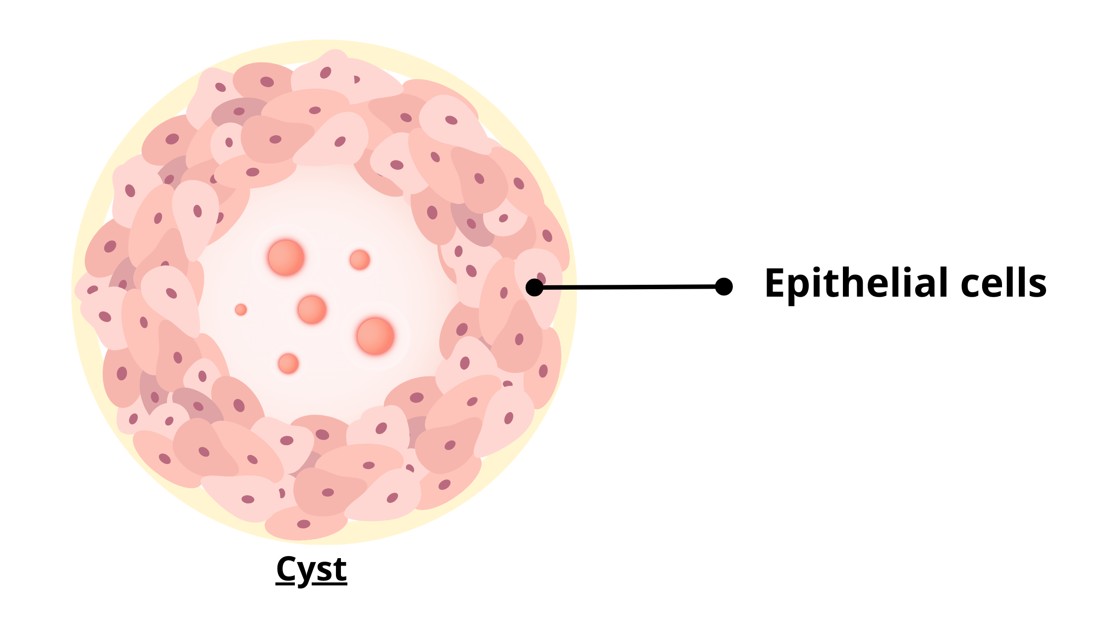 cystic cavity lined with epithelial cells