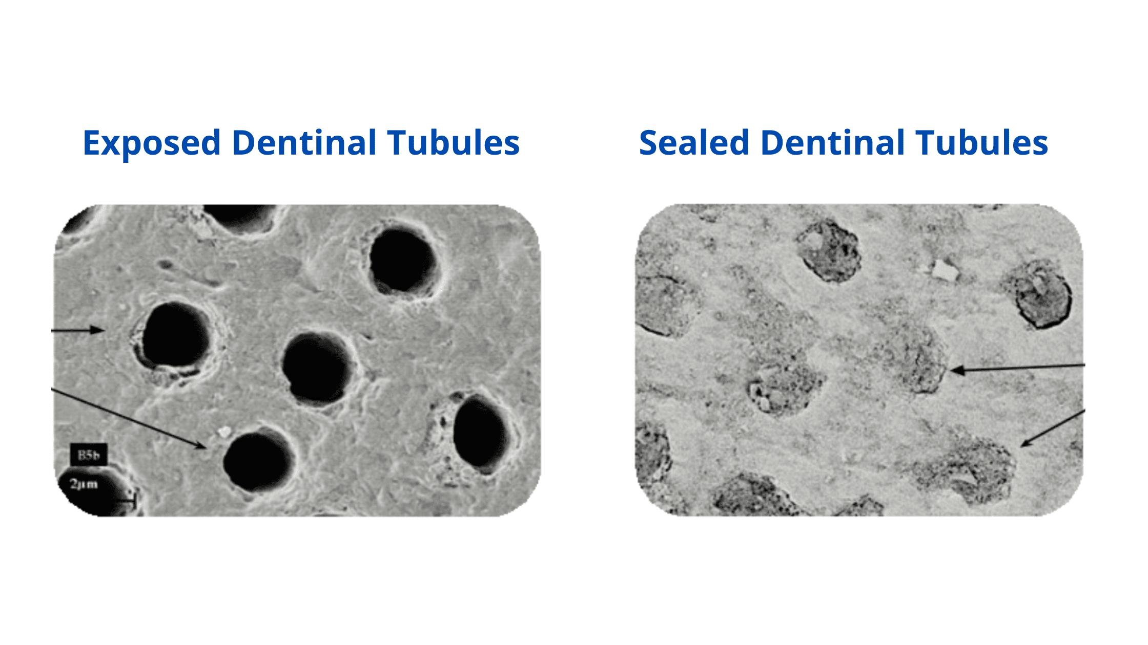 Dentinal tubules sealed after application of a remineralizing agent