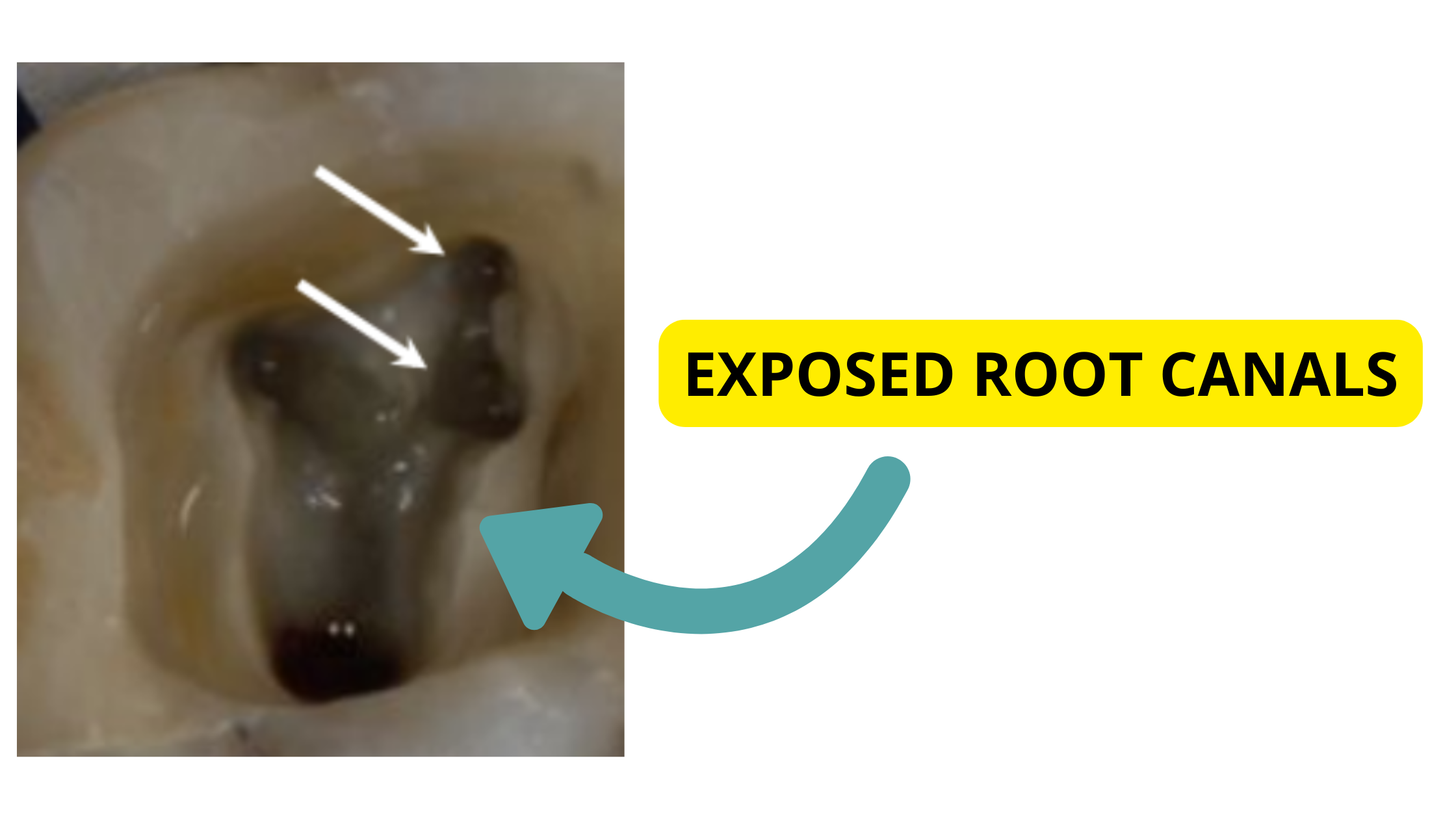 exposed root canals and unfinished treatment