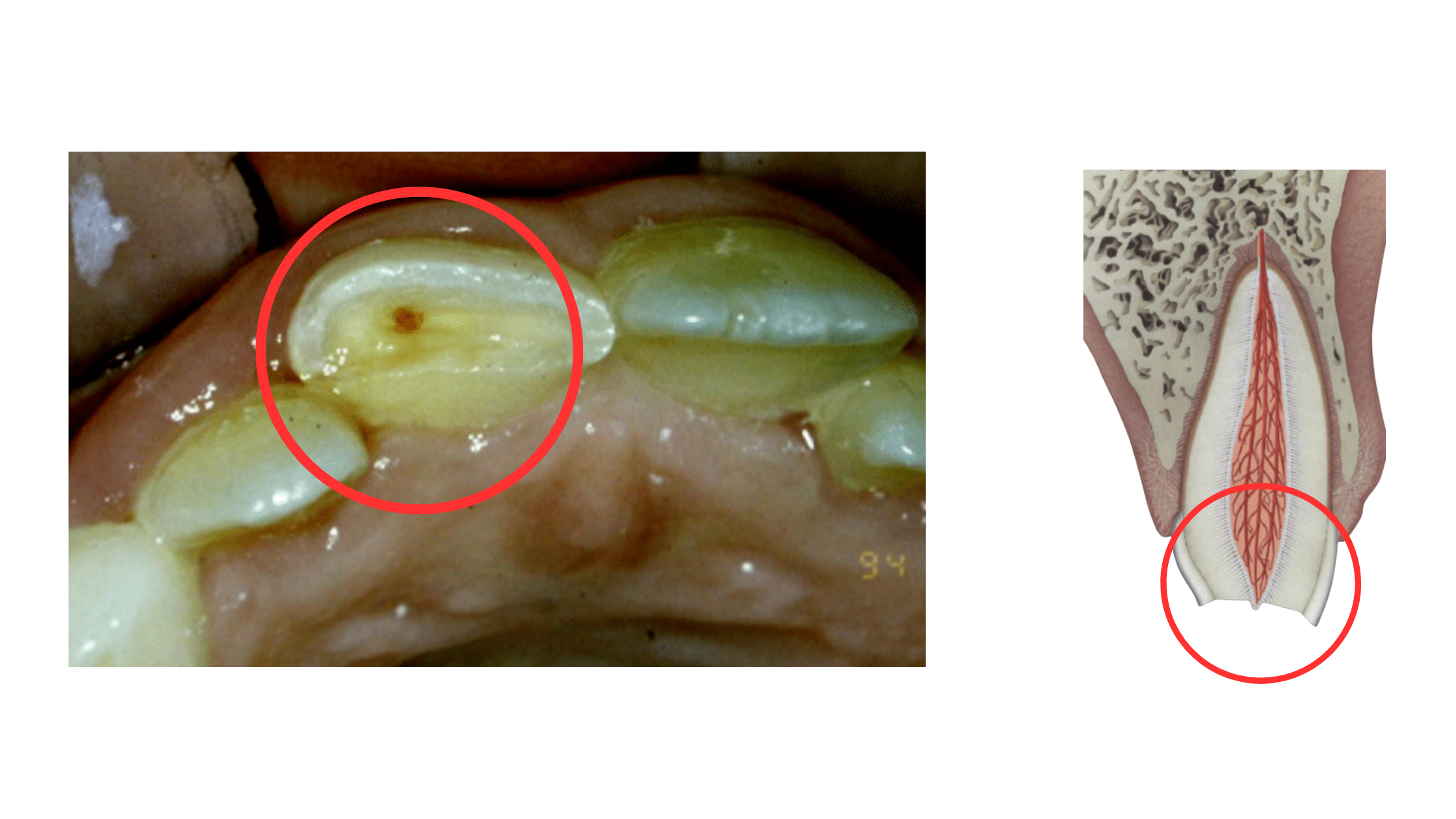 Exposed tooth nerves due to trauma