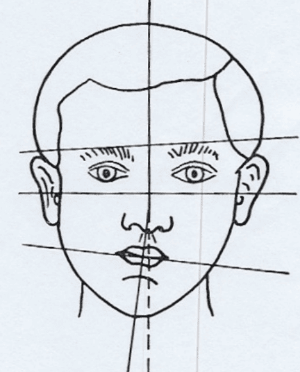 Facial asymmetry: Lower jaw deviated to one side