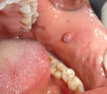 Bump inside the cheeks indicating benign fibroma