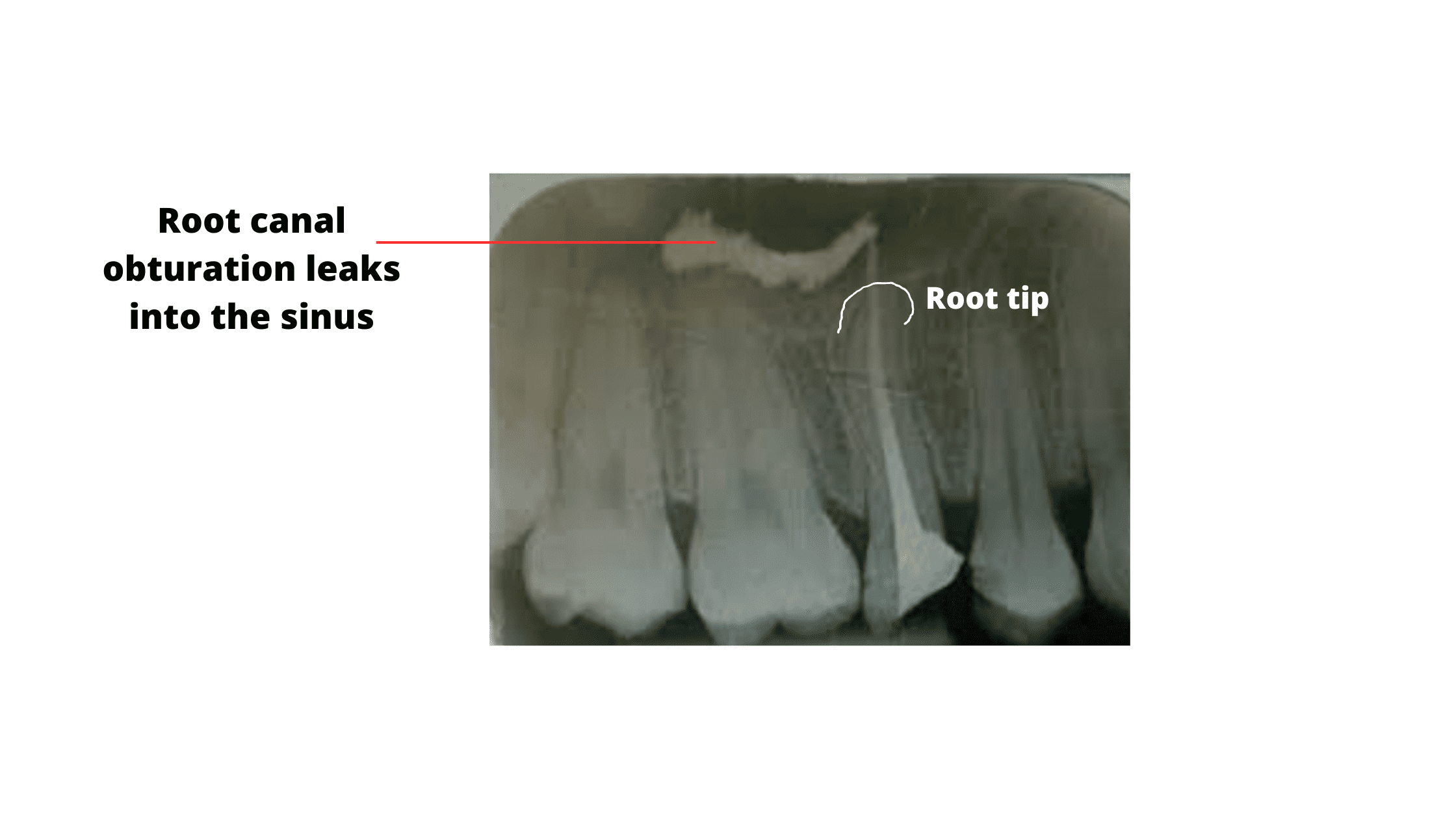 Root canal filling leakage into the sinus