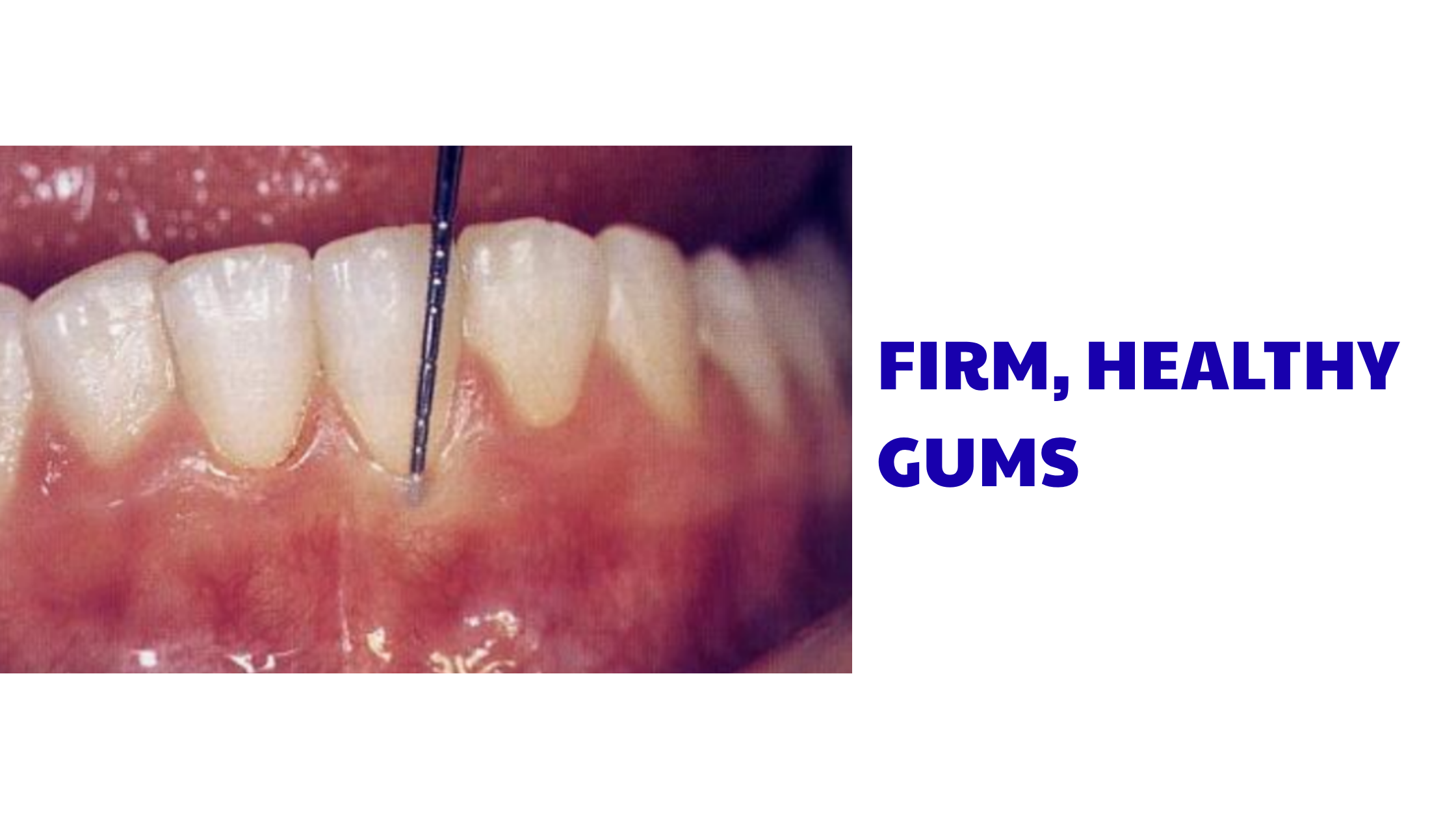 Firm healthy gums