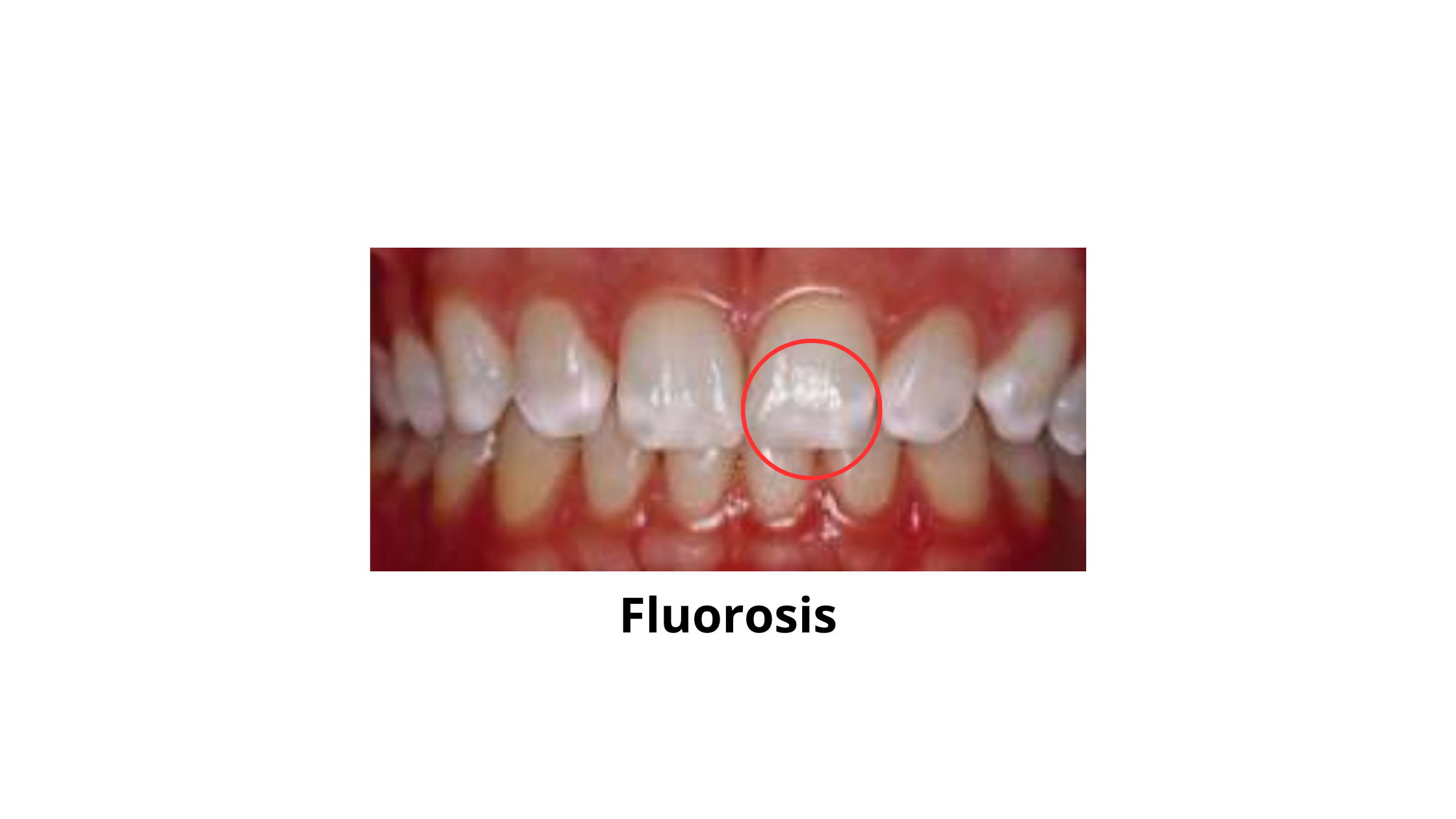 fluorosis leading to white spots on the front teeth