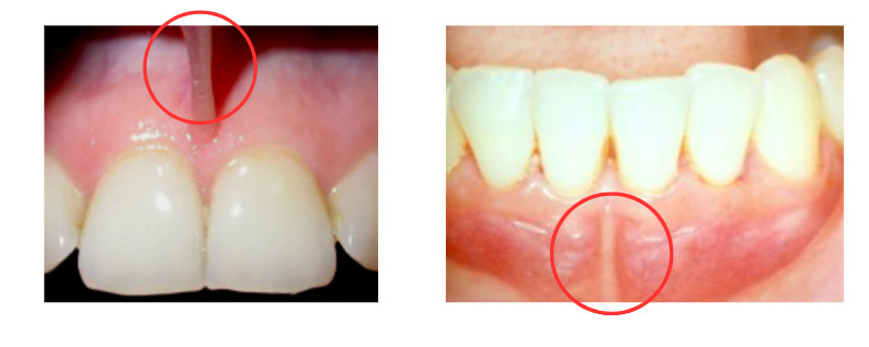 frenulum insertion near the marginal gum and gum recession