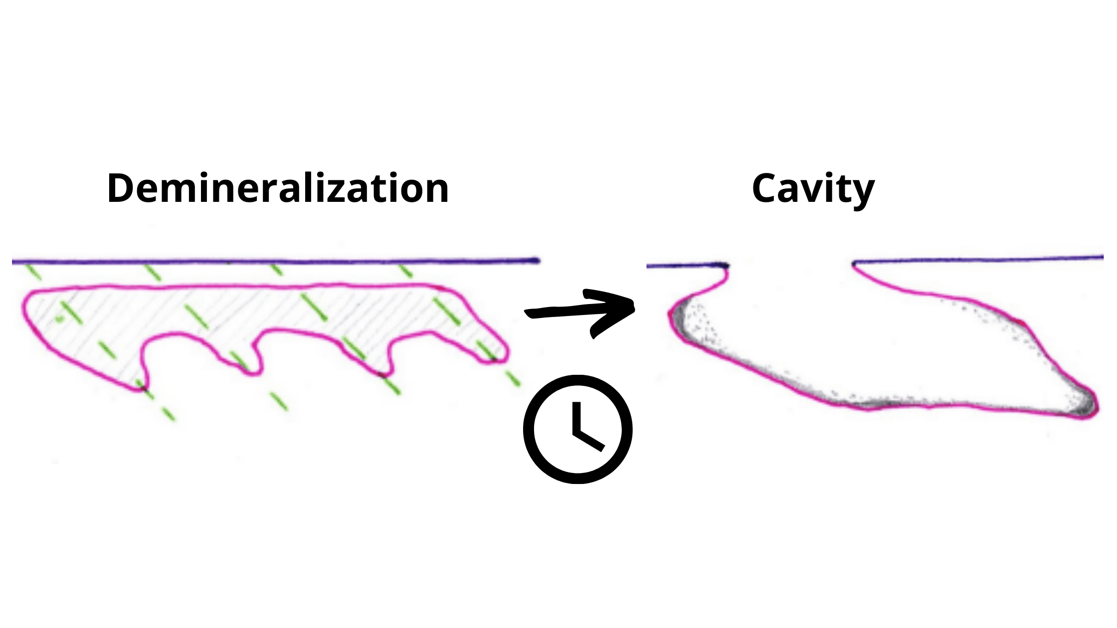 Progression from the white spot to the cavity