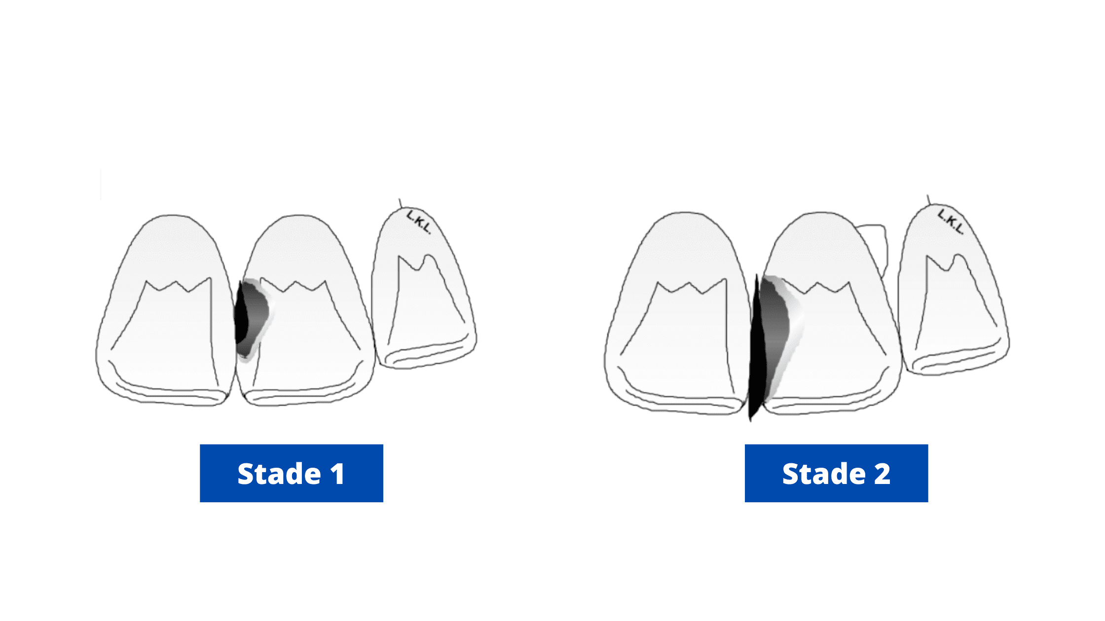 Cavity stages on front teeth