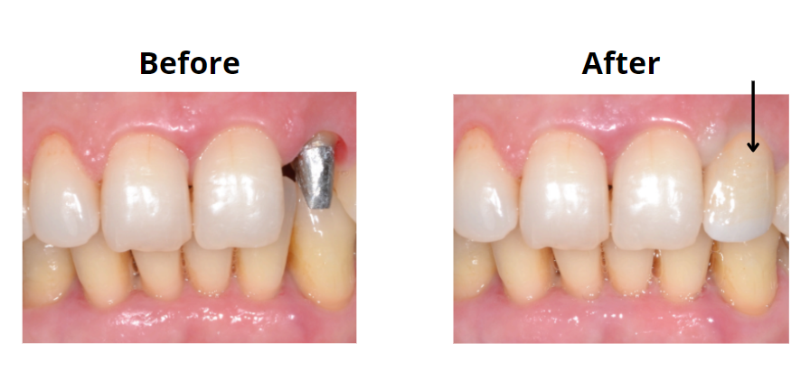 front tooth crown before and after 