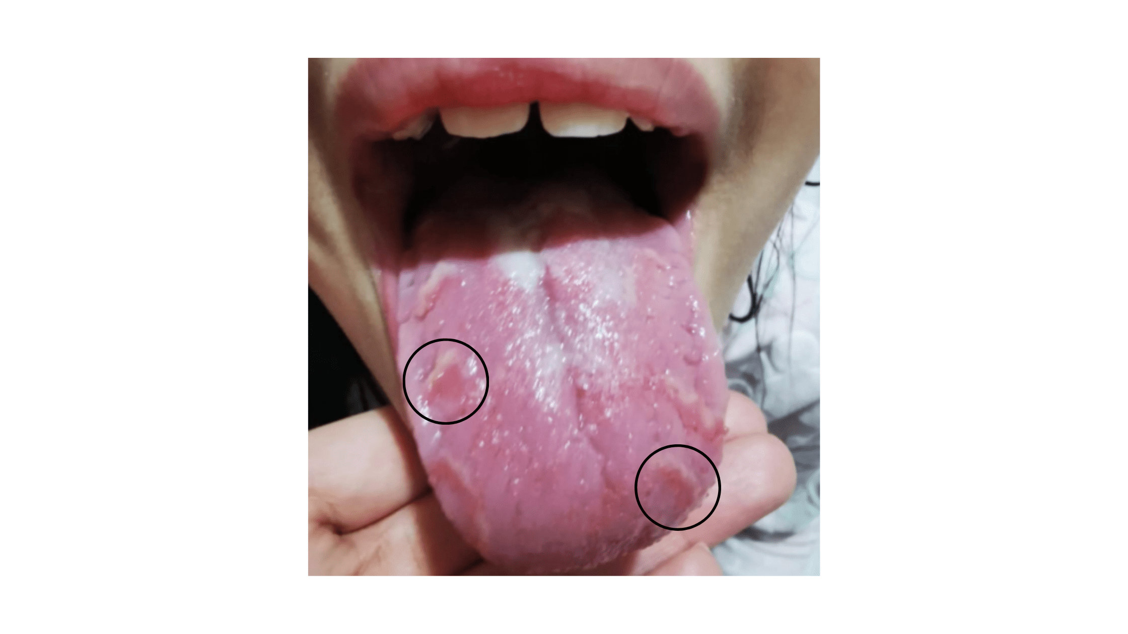 Clinical case of geographic tongue