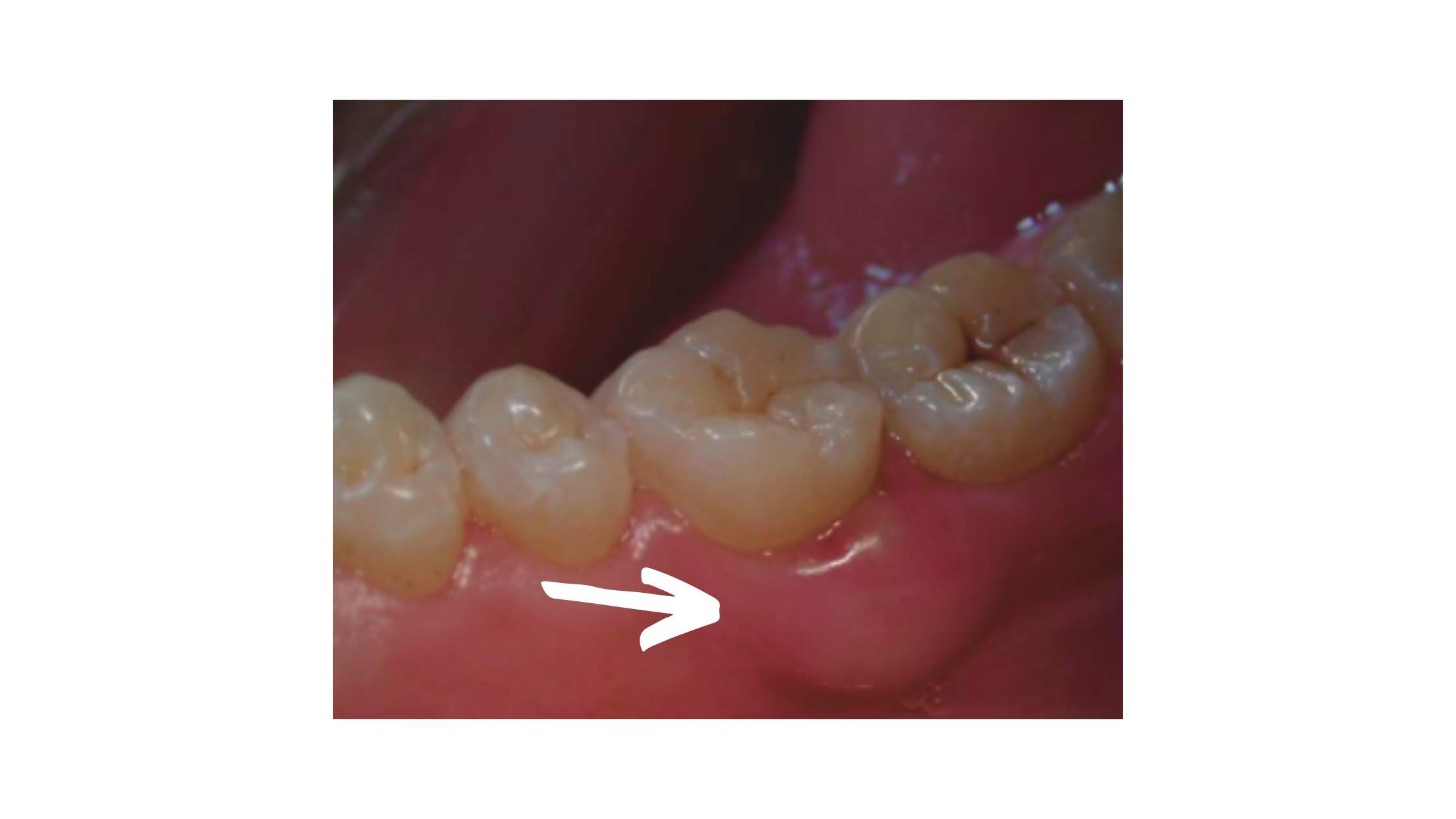 Clinical image of gingival abscess