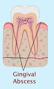 gingival abscess