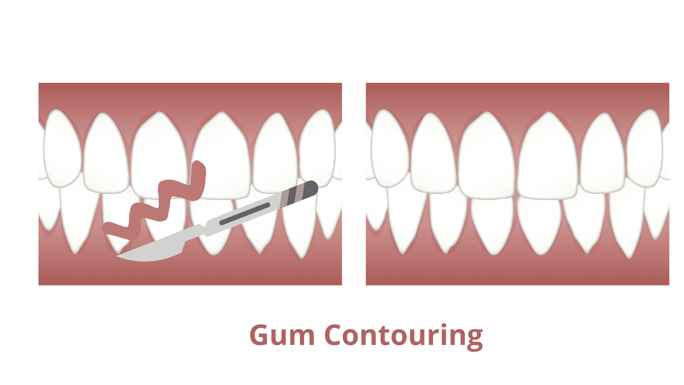 gingivoplasty or gum recontouring after gum graft surgery
