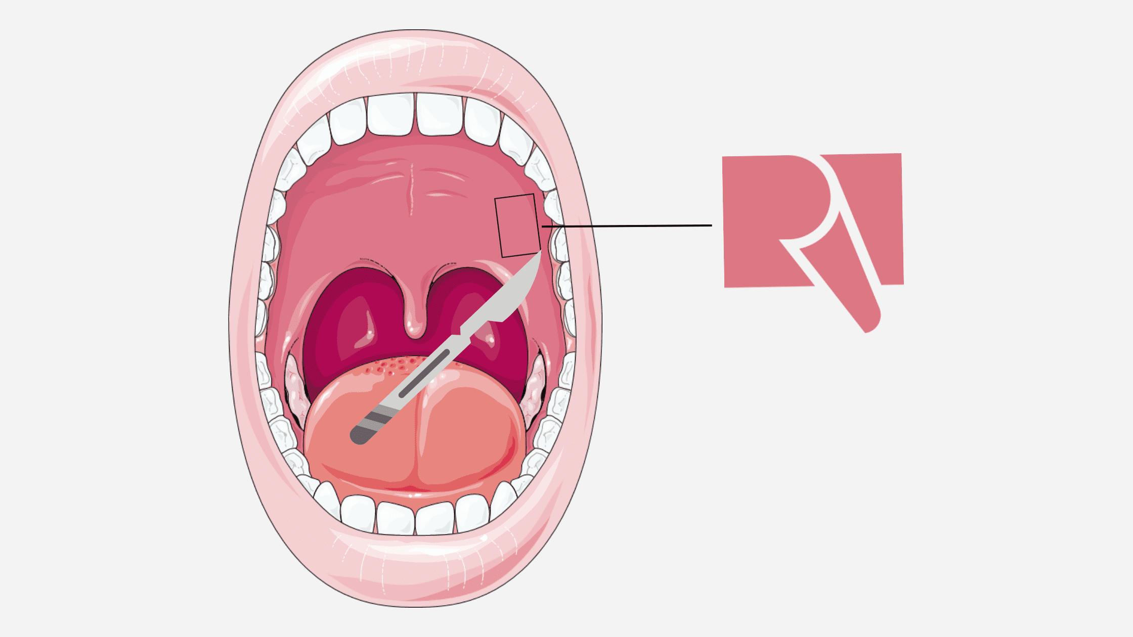 Harvesting soft tissue from the palate