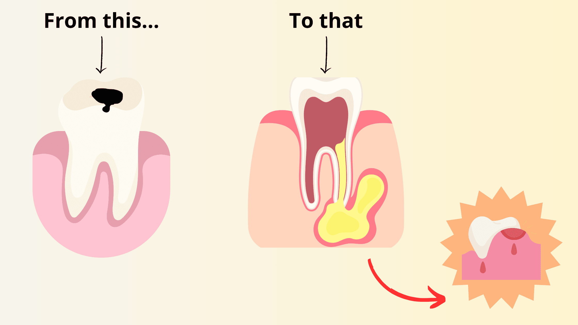 Gum abscess formation process