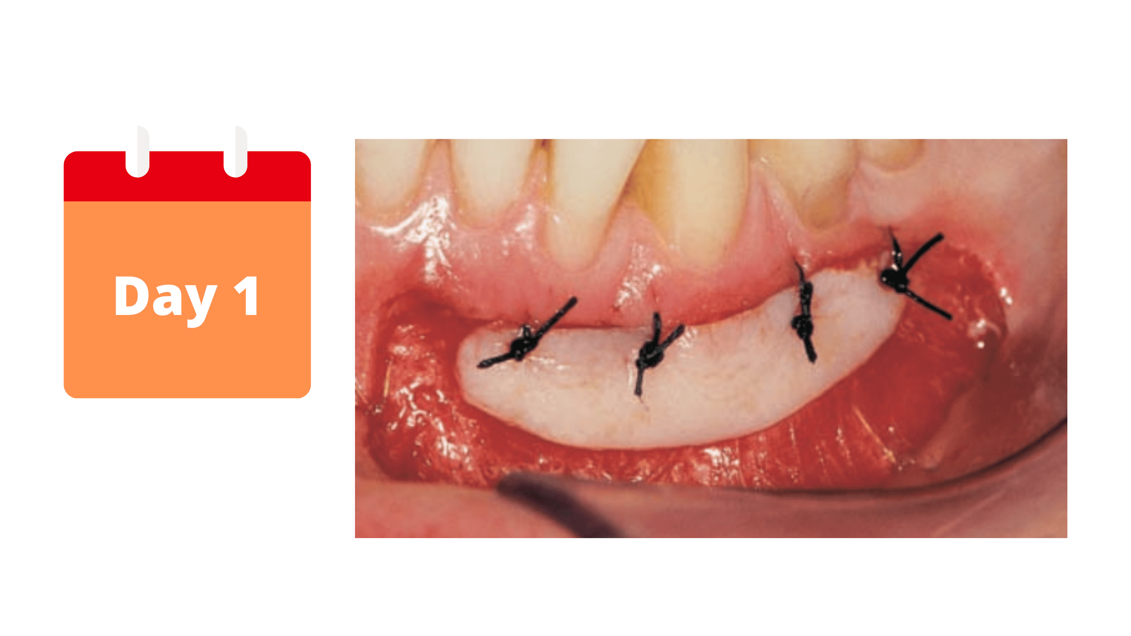 The first stage of gum graft healing: Immediately after the procedure 