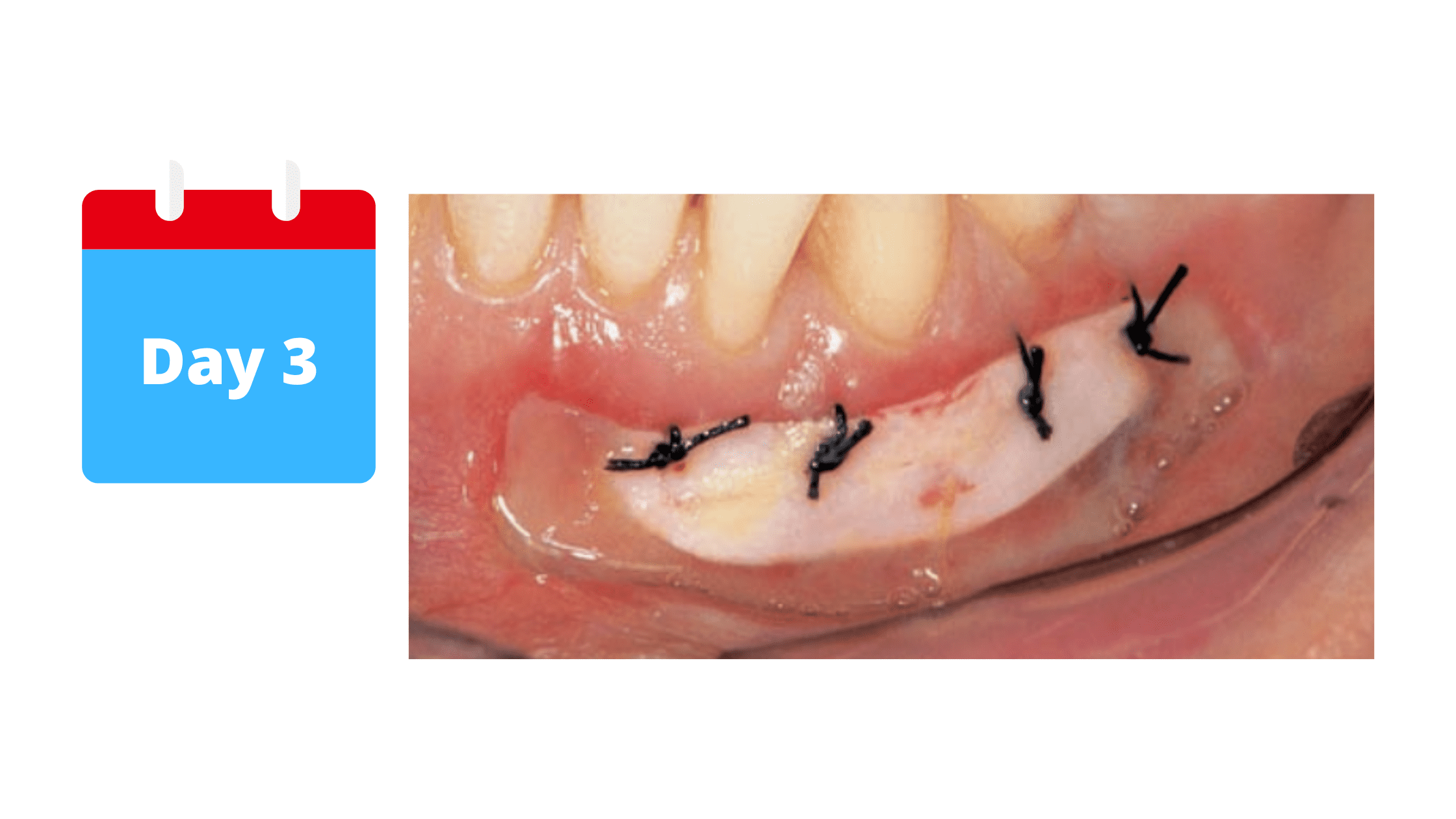 The second stage of gum graft healing 