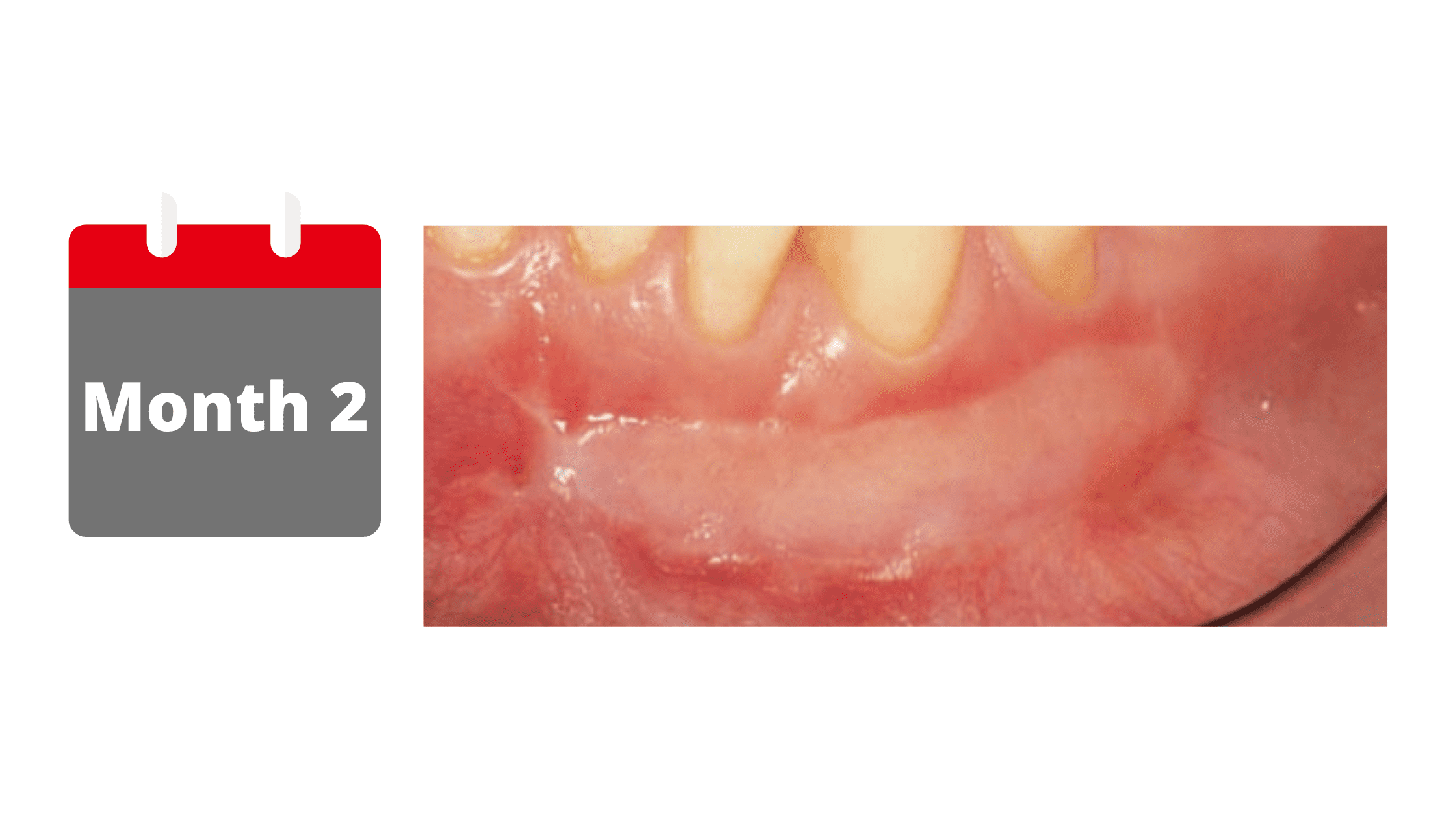 The fourth stage of gum graft healing: After 2 months 