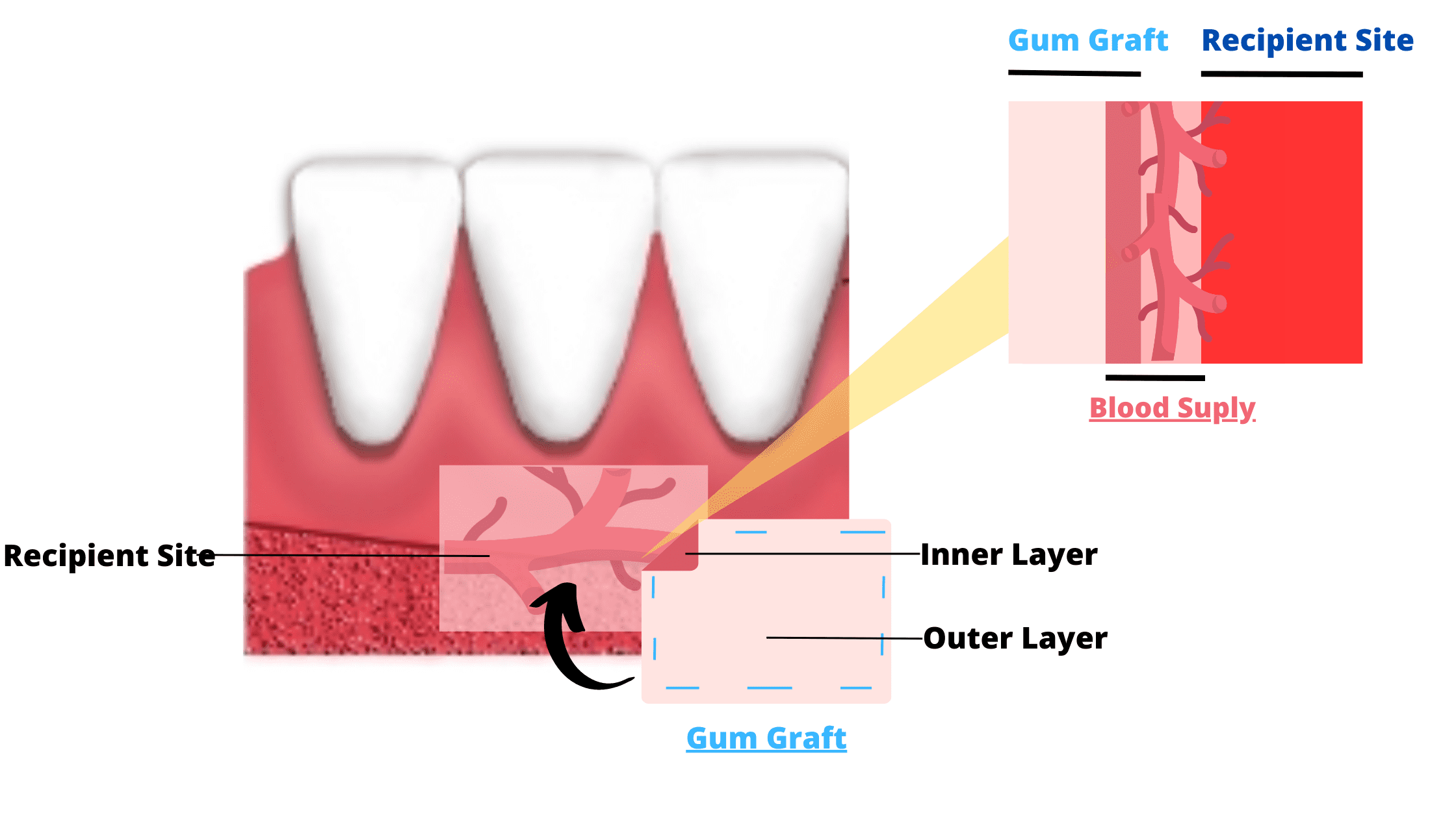 Blood circulation of the gingival graft after being sutured in the recipient site