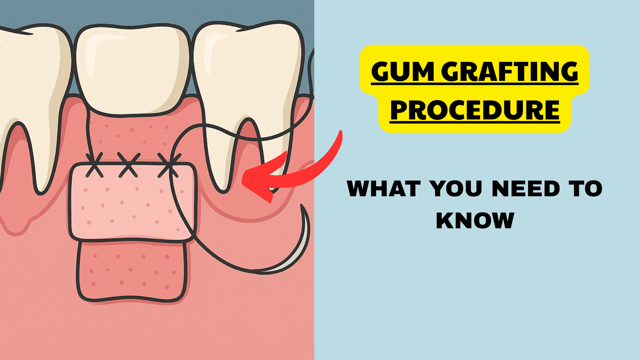 Gum graft surgery: what you need to know