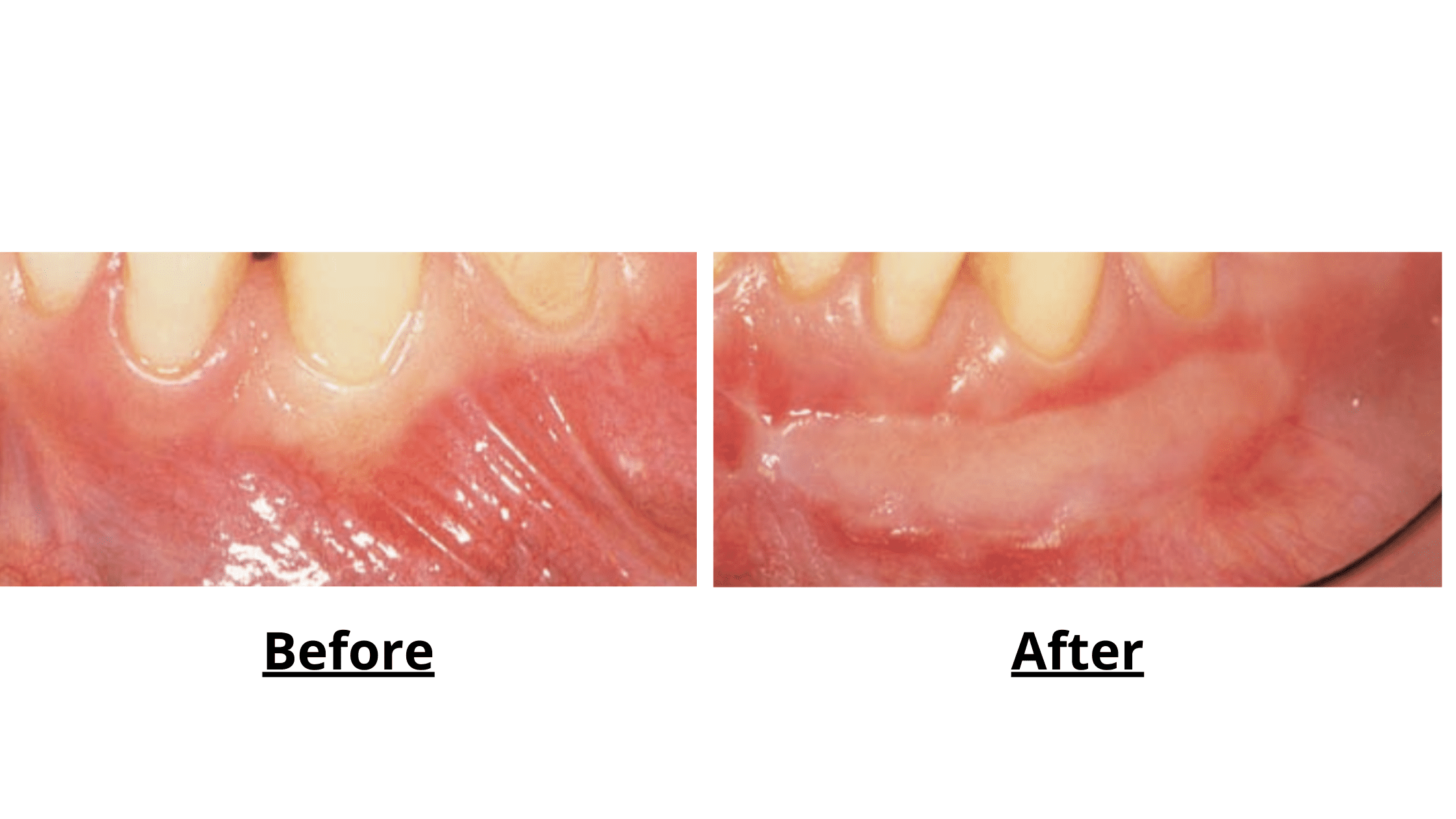 Free gingival graft turning pale pink after the healing and maturing
