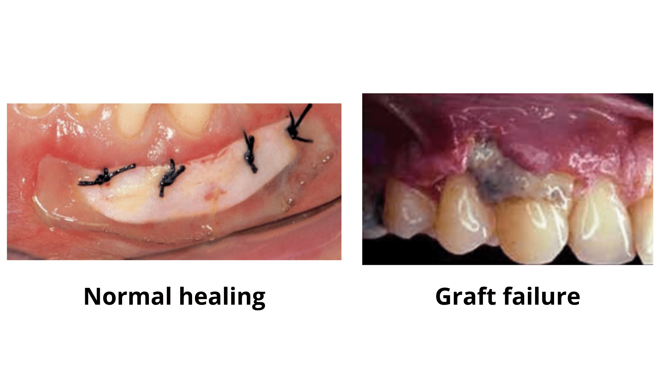 Gum graft turning white: Medical image comparing failure vs. Normal Healing