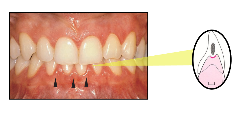 Gum pain between teeth