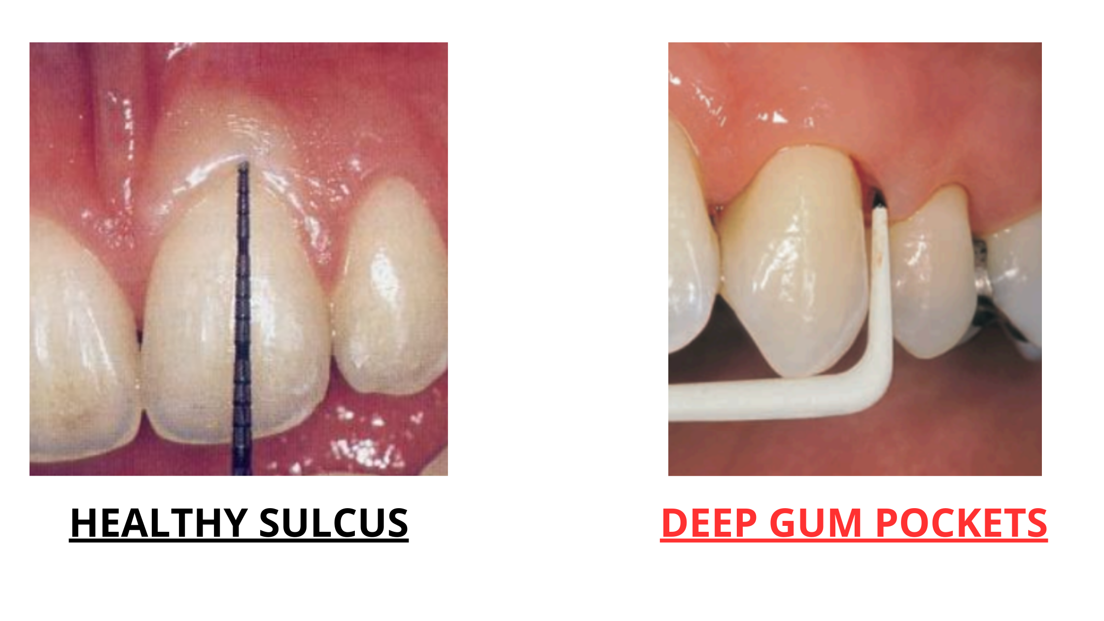 Gum pockets vs healthy sulcus