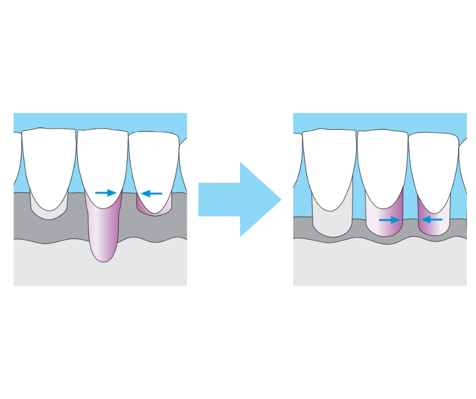 gum recession stages following gum disease