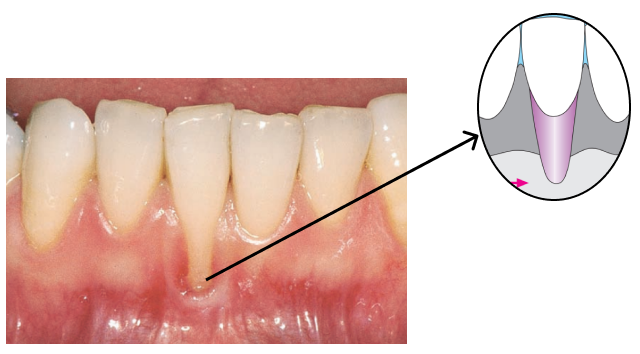 gum recession in one tooth