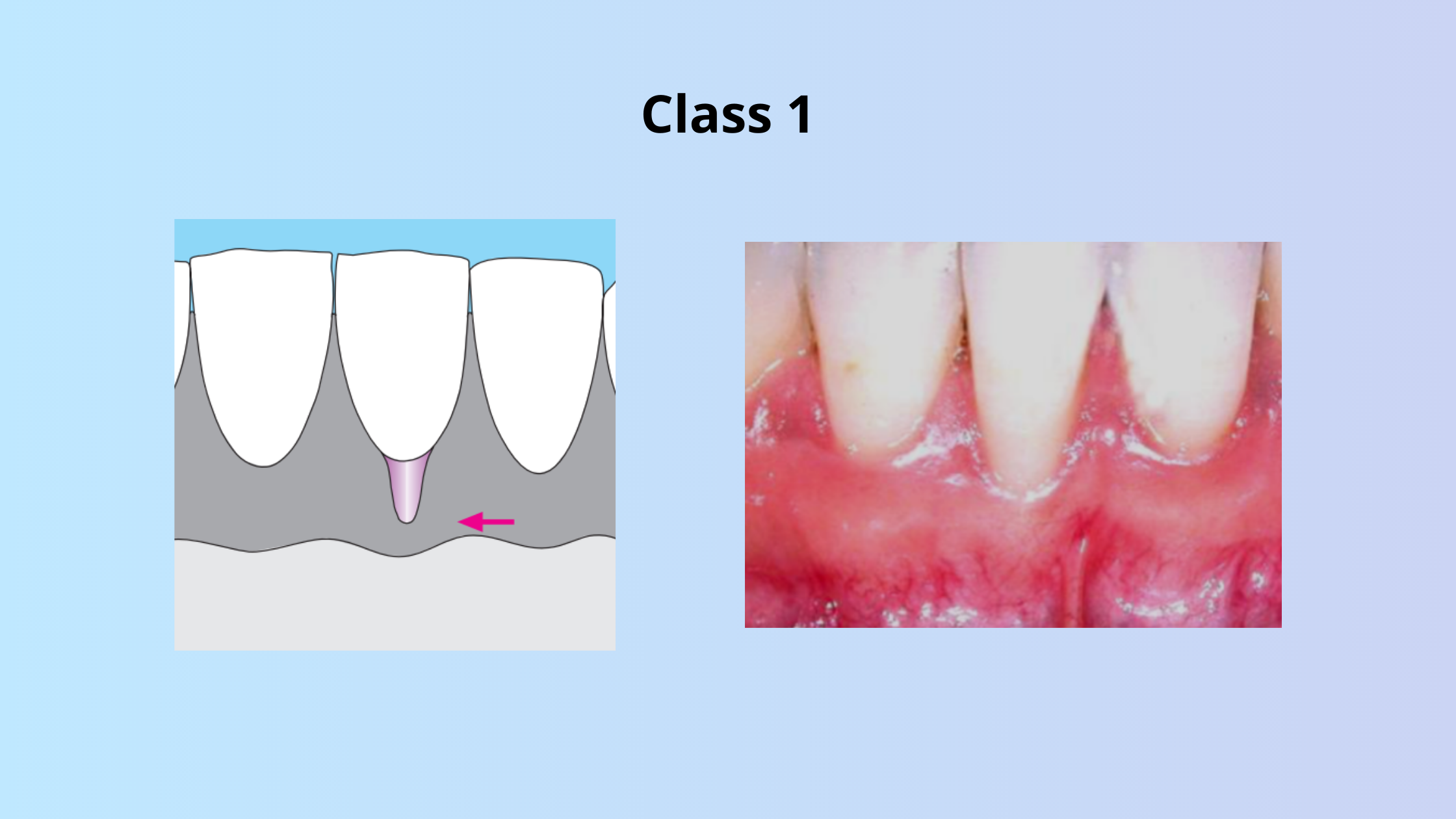 Class 1 of gingival recession according to Miller
