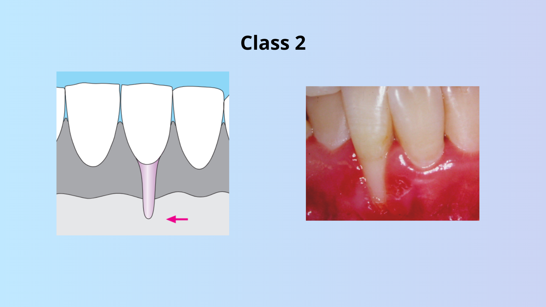 Class 2 of gingival recession according to Miller