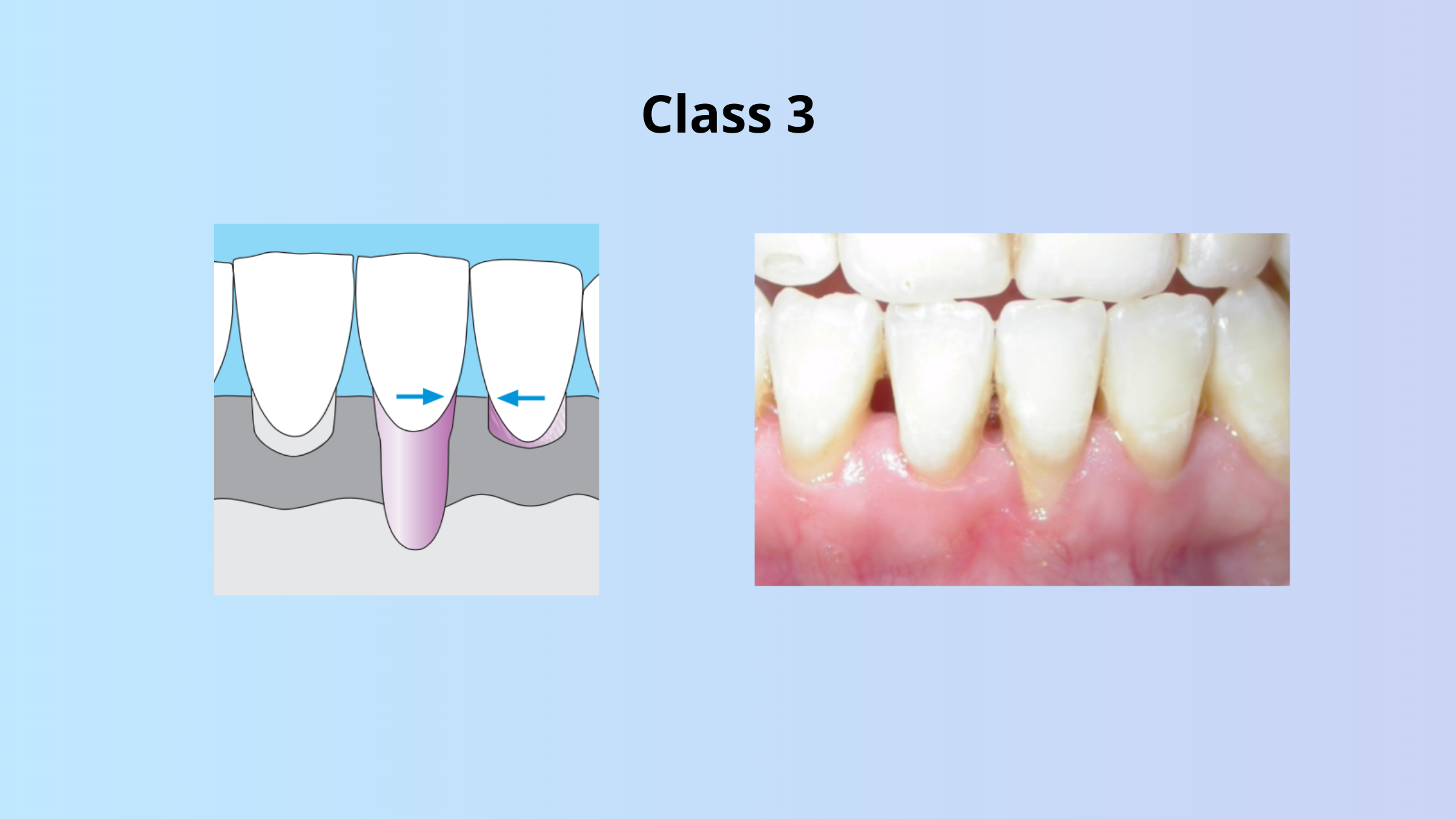 Class 3 of gingival recession according to Miller
