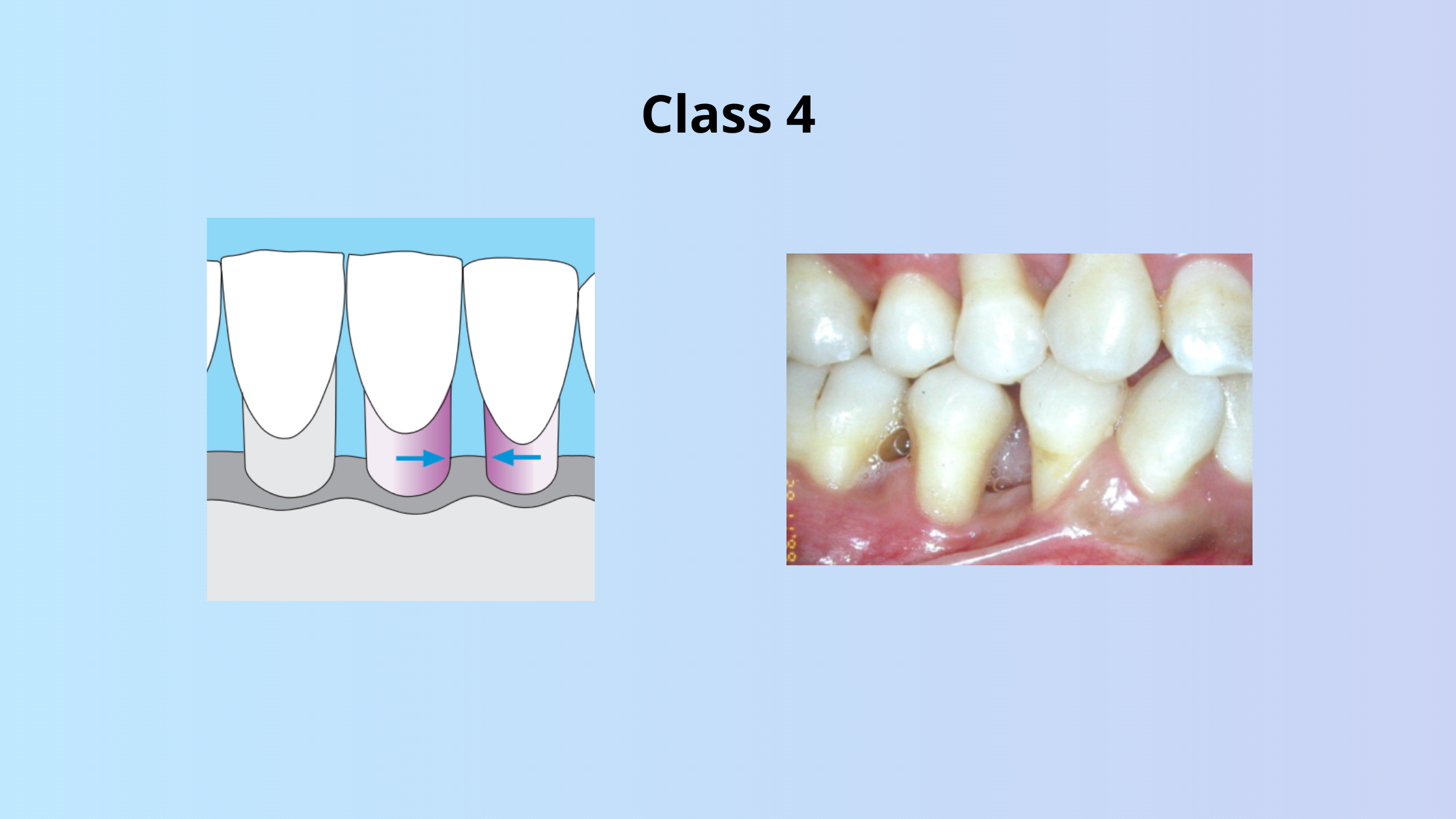 Class 4 of gingival recession according to Miller
