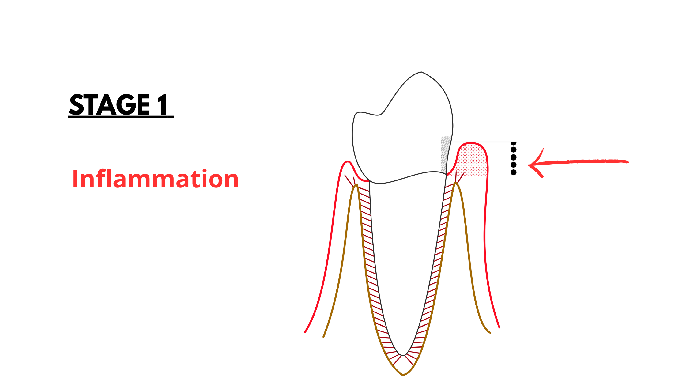 the first stage of gum recession: inflammation
