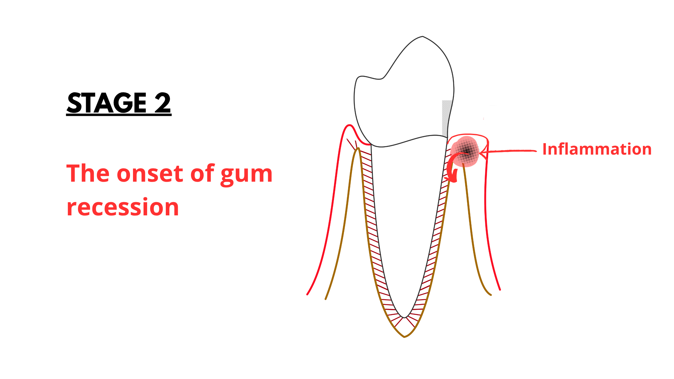 the 2nd stage of gum recession: the onset of the condition