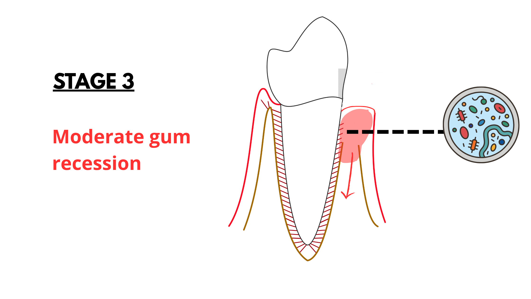 the 3rd stage of gum recession: Moderate recession