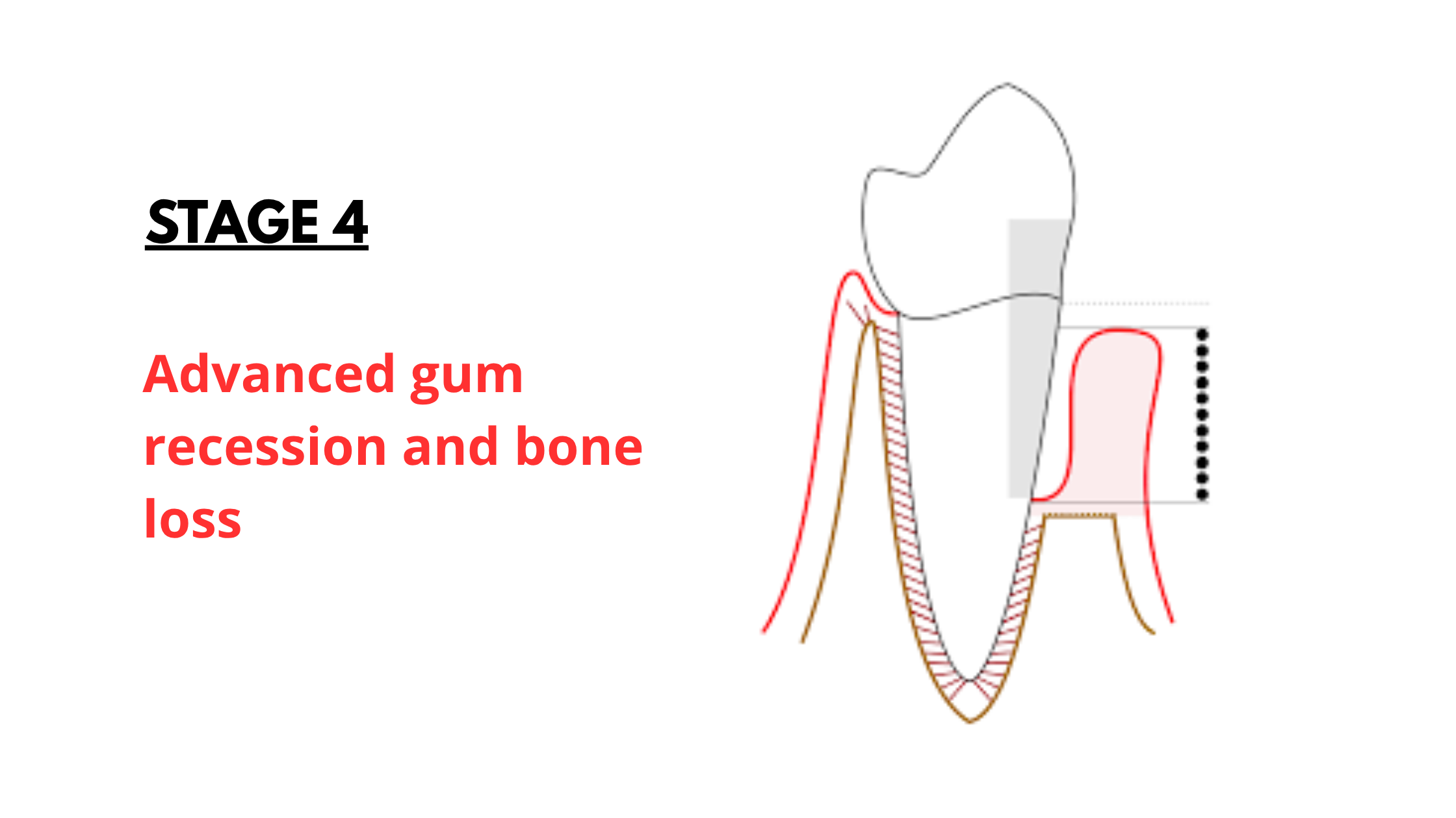 the 4rd stage of gum recession: Severe Gum Recession and Extensive Bone Loss