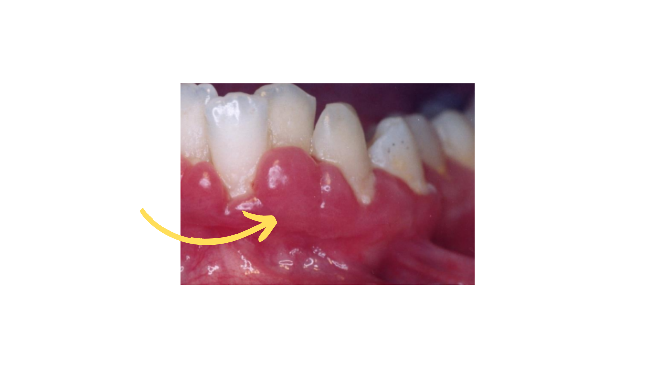 Gum swelling