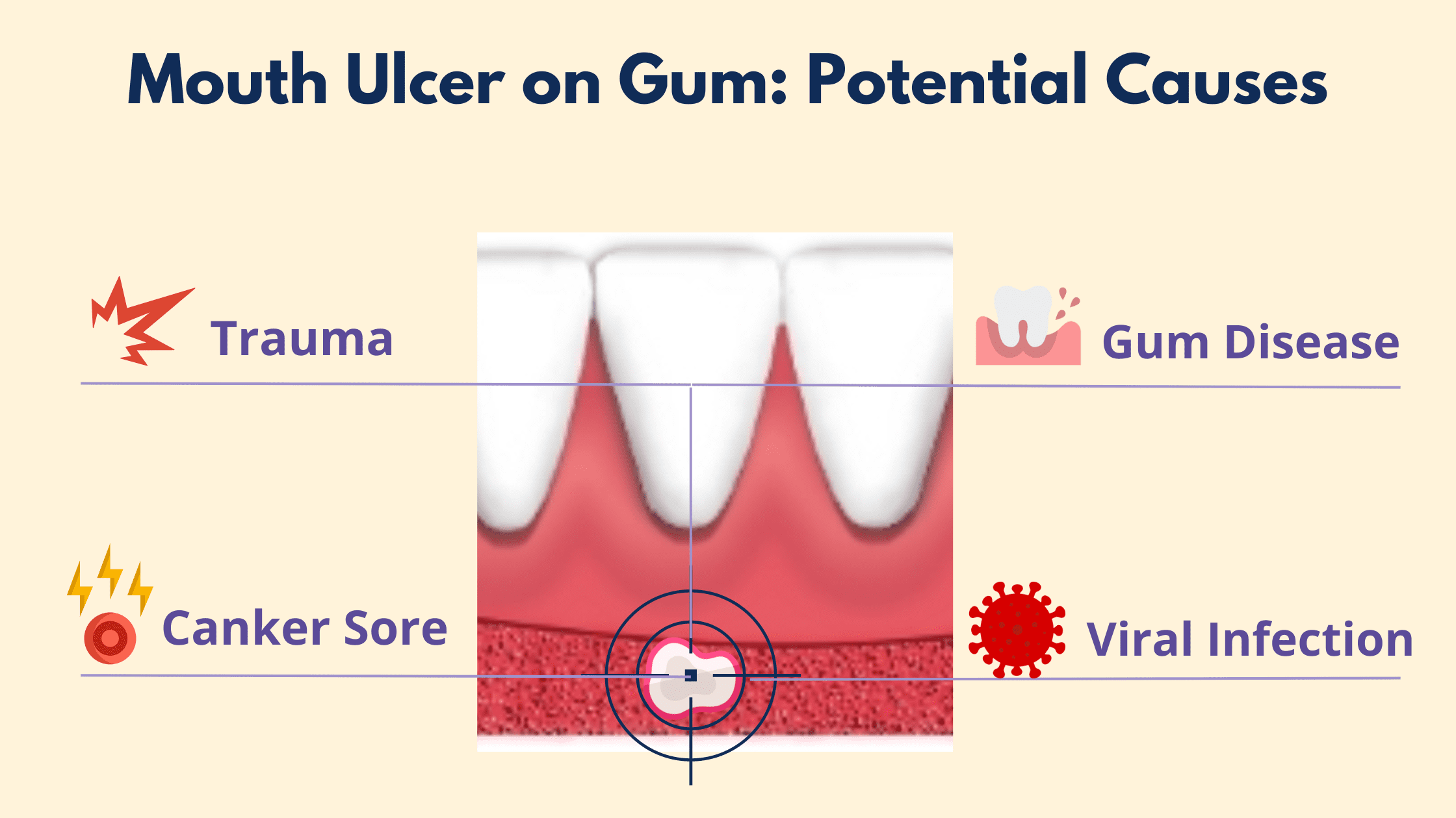 Ulcer on Gum: Potential Causes