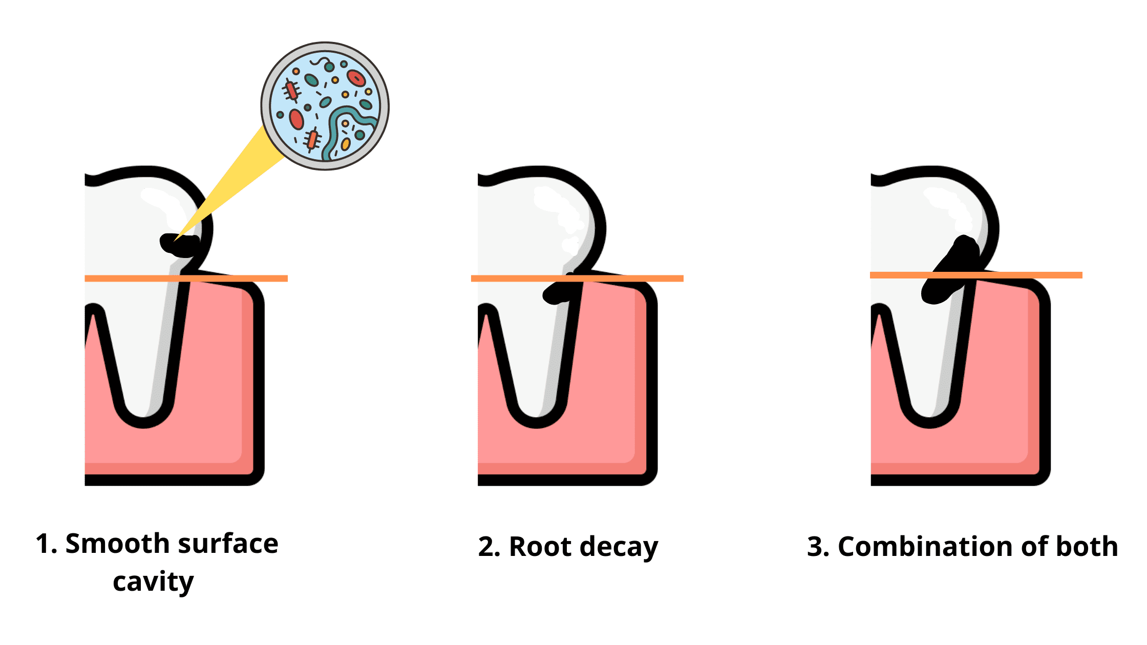 The different types of gumline cavities