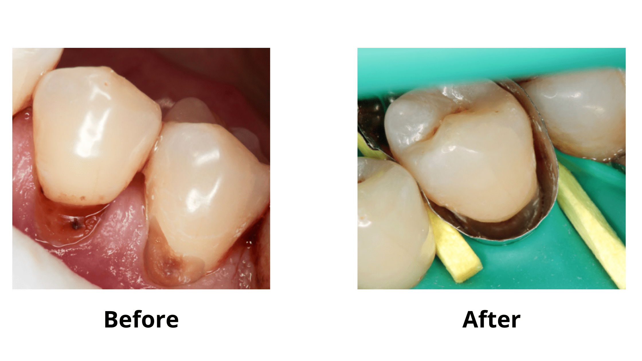 Tooth decay at the gum line treatment: decay removal and composite filling